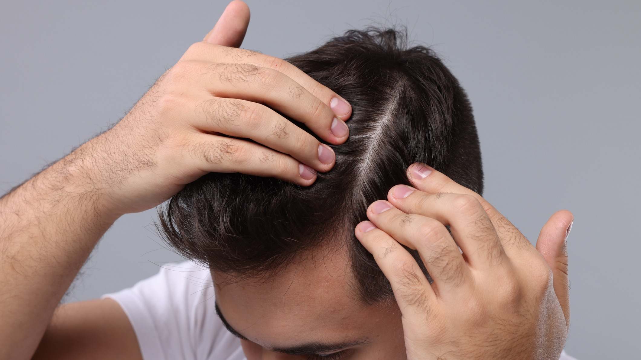 Caída de pelo en hombres