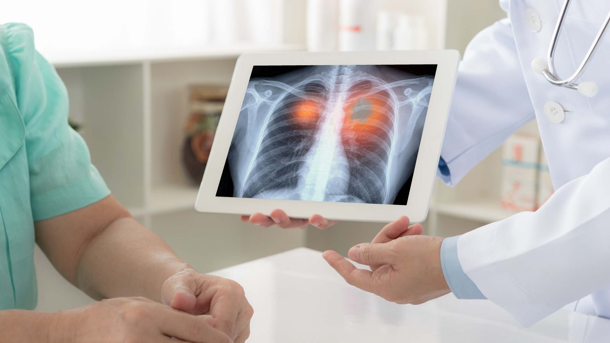 Médico mostrándole a un paciente en una tablet una radiografía su cáncer de pulmón
