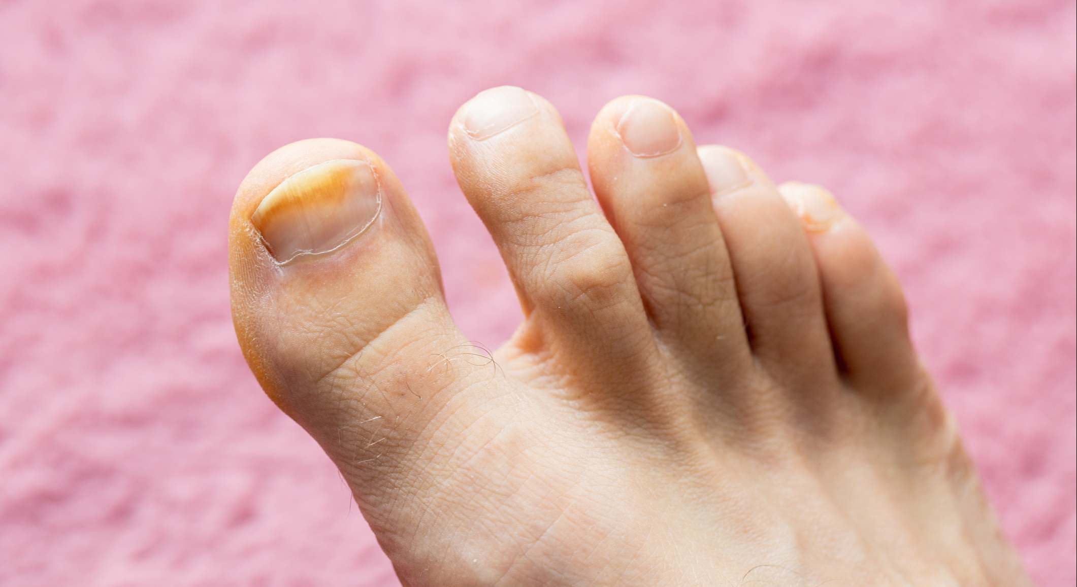 Uñas de los pies | Foto: iStock