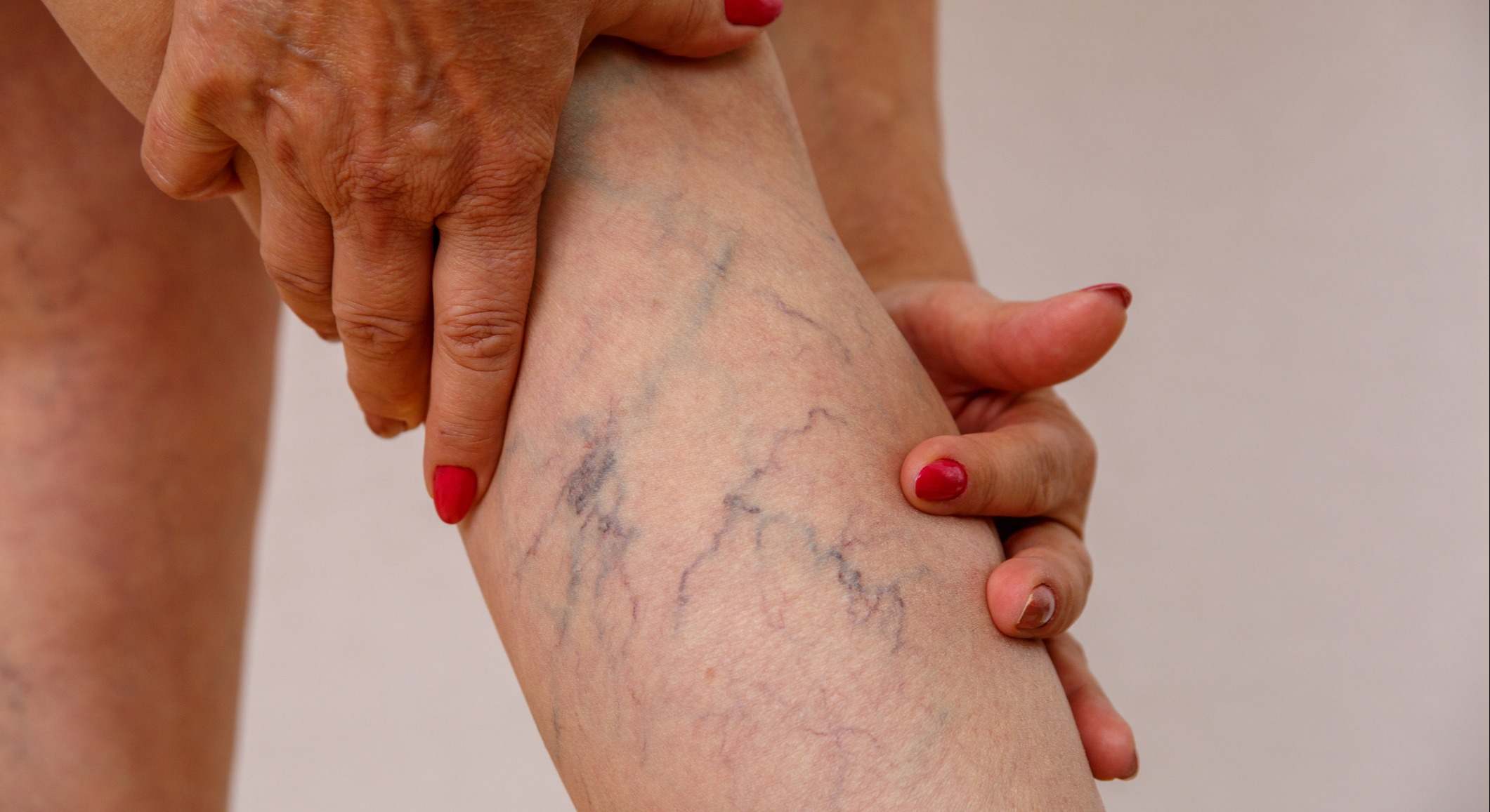Varices