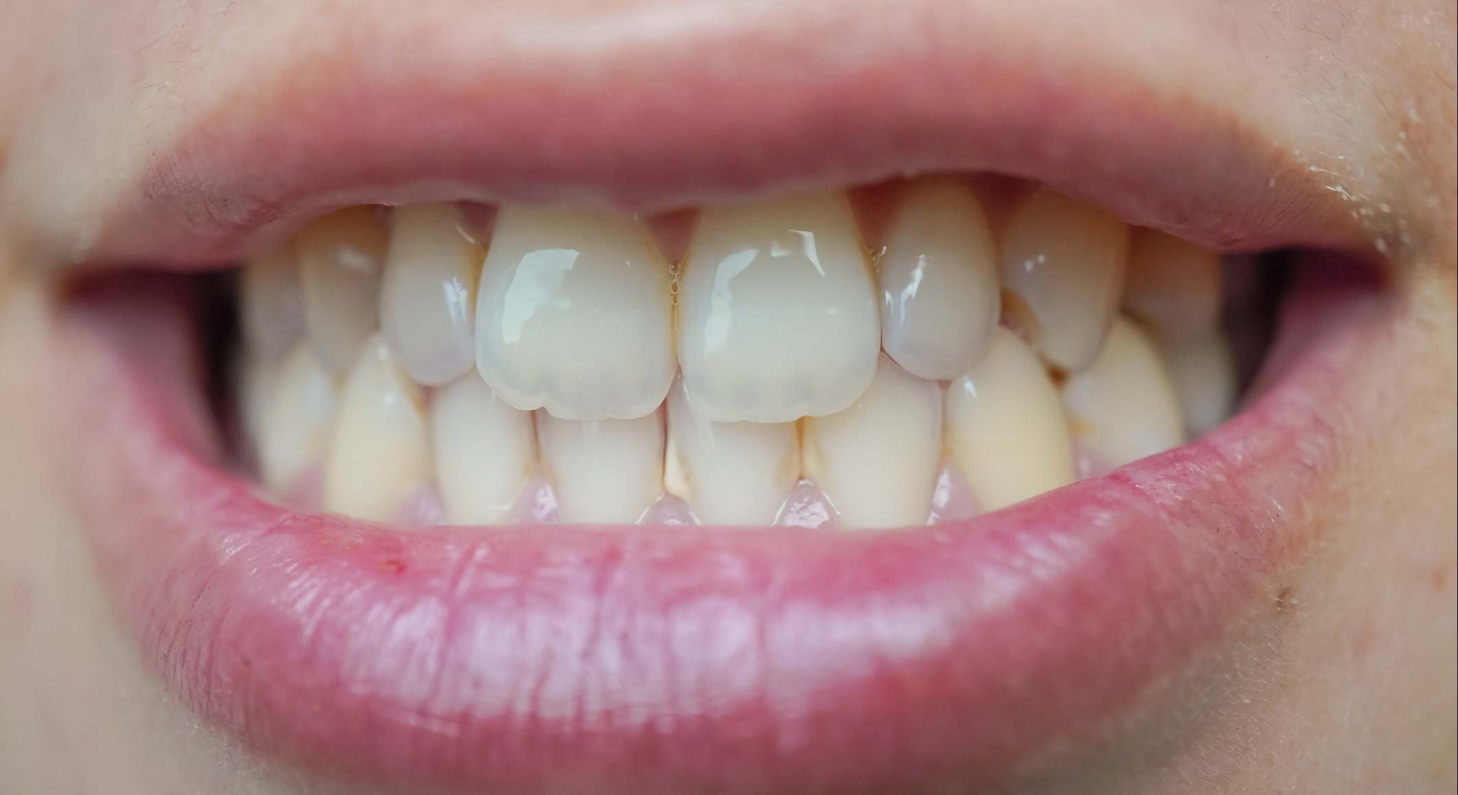 Foto de primer plano de los dientes de una mujer que contienen placa dental