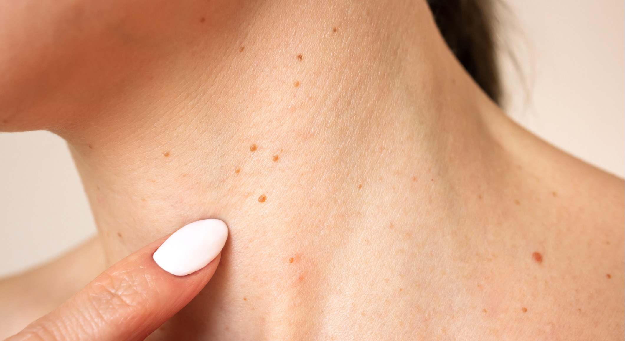 Mujer que tiene varias verrugas en el cuello