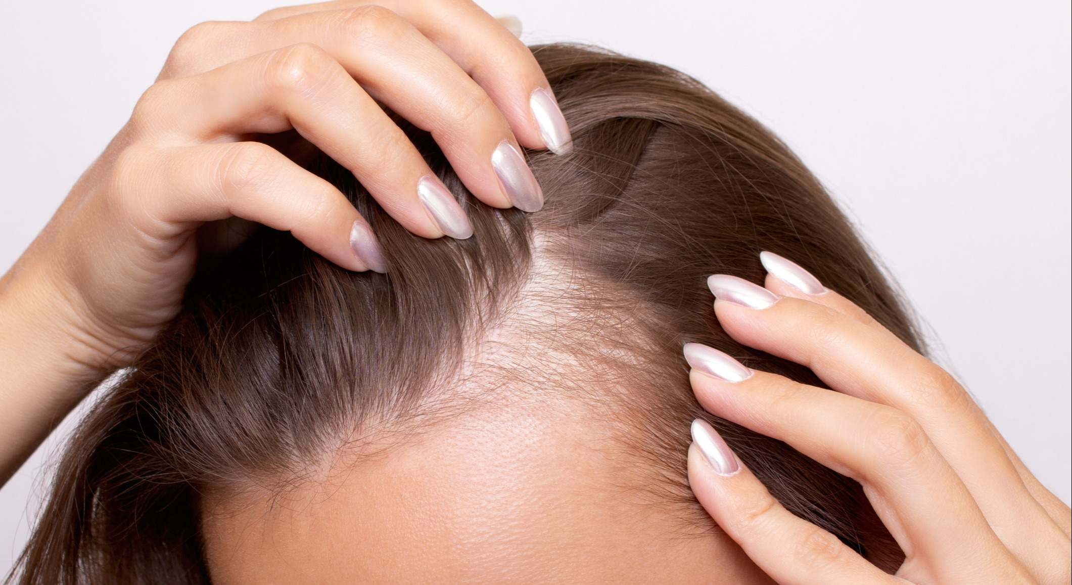 Alopecia