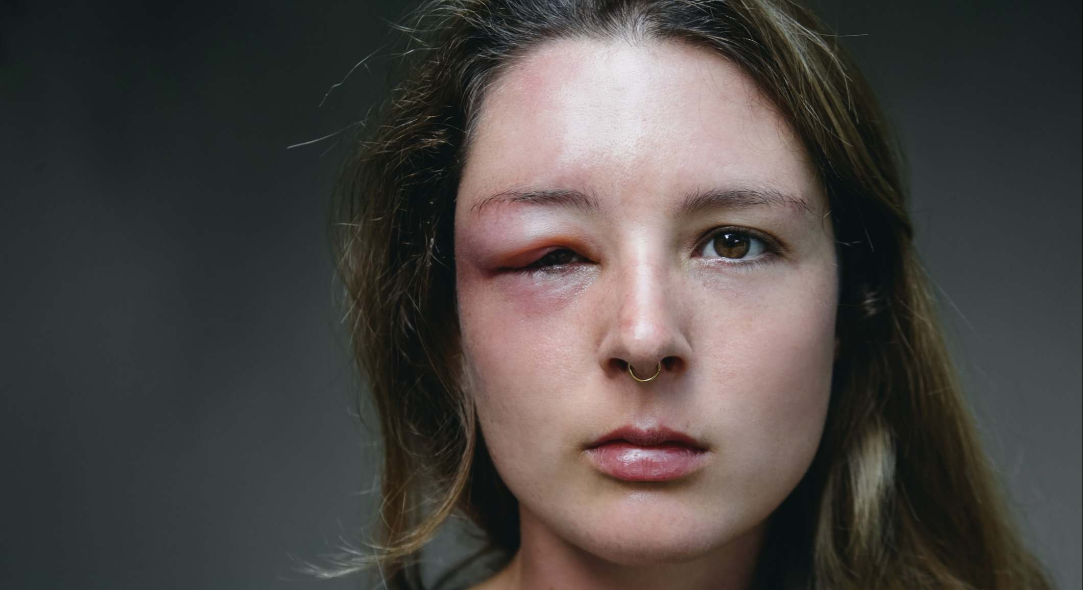 Joven mujer caucásica con un ojo hinchado de la picadura de una avispa