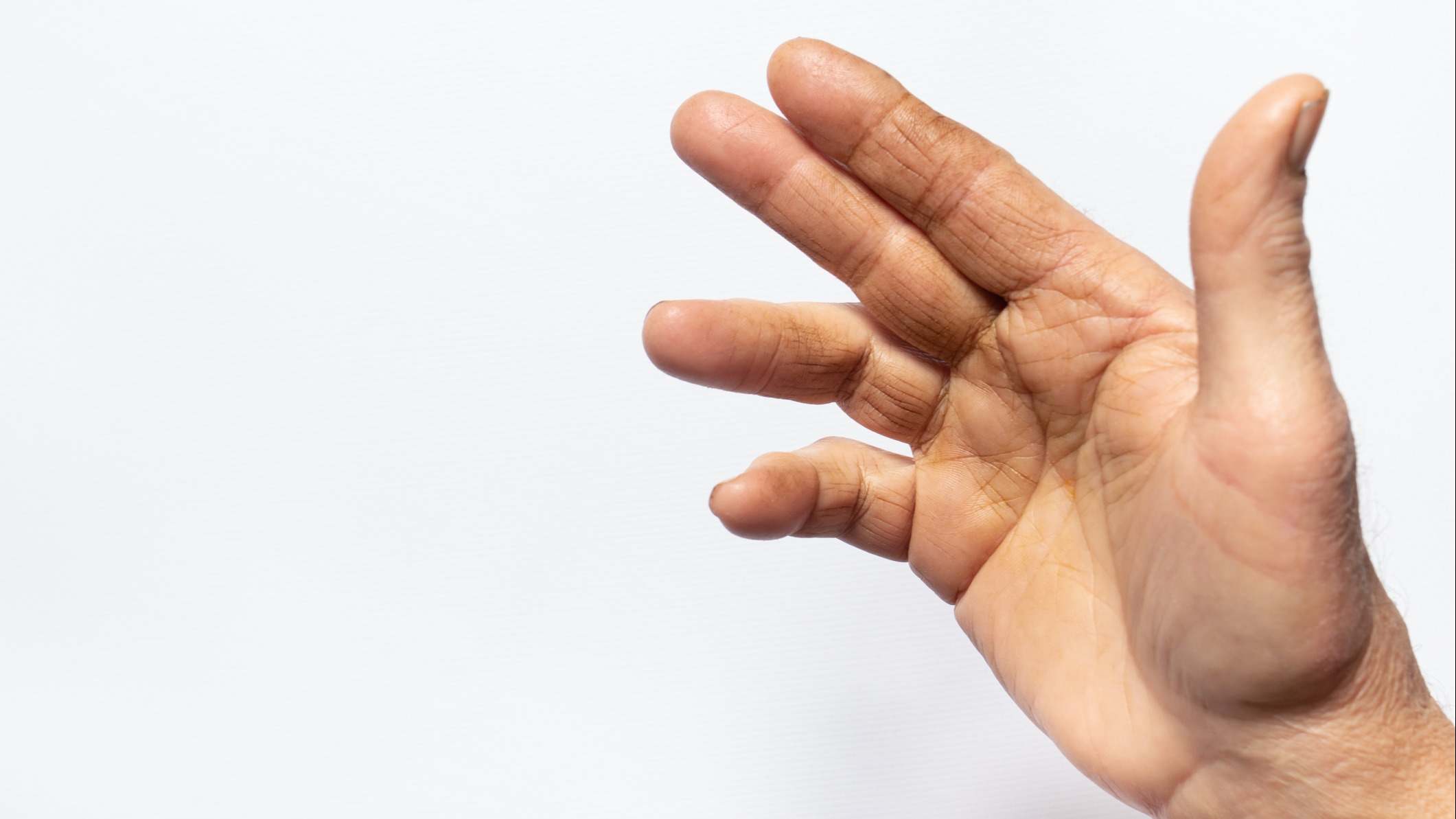 Mano de una persona que padece la contractura de Dupuytren