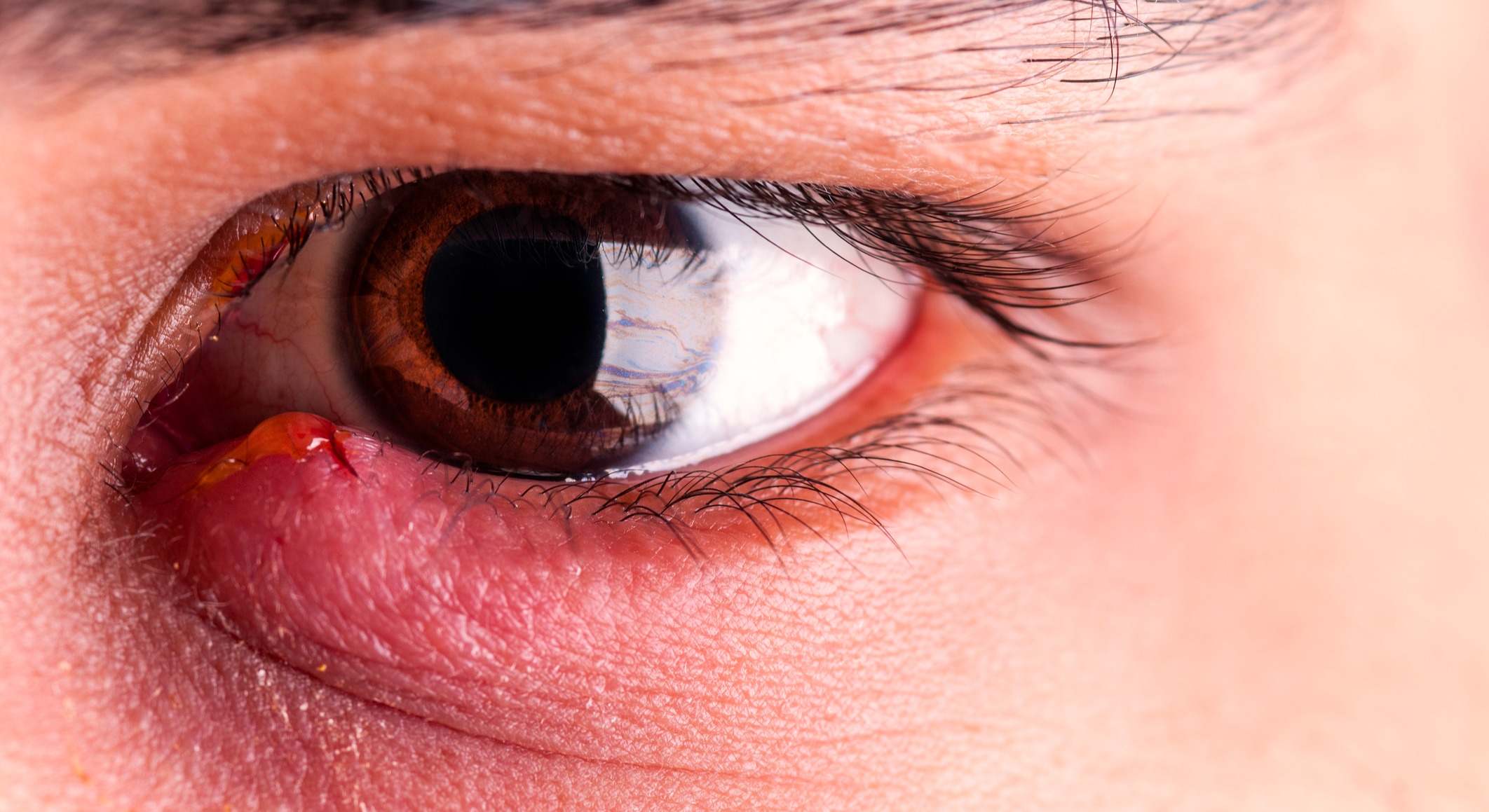 Ojos hinchados