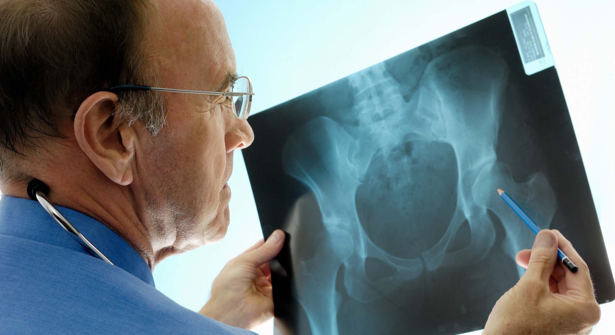 Osteoporosis