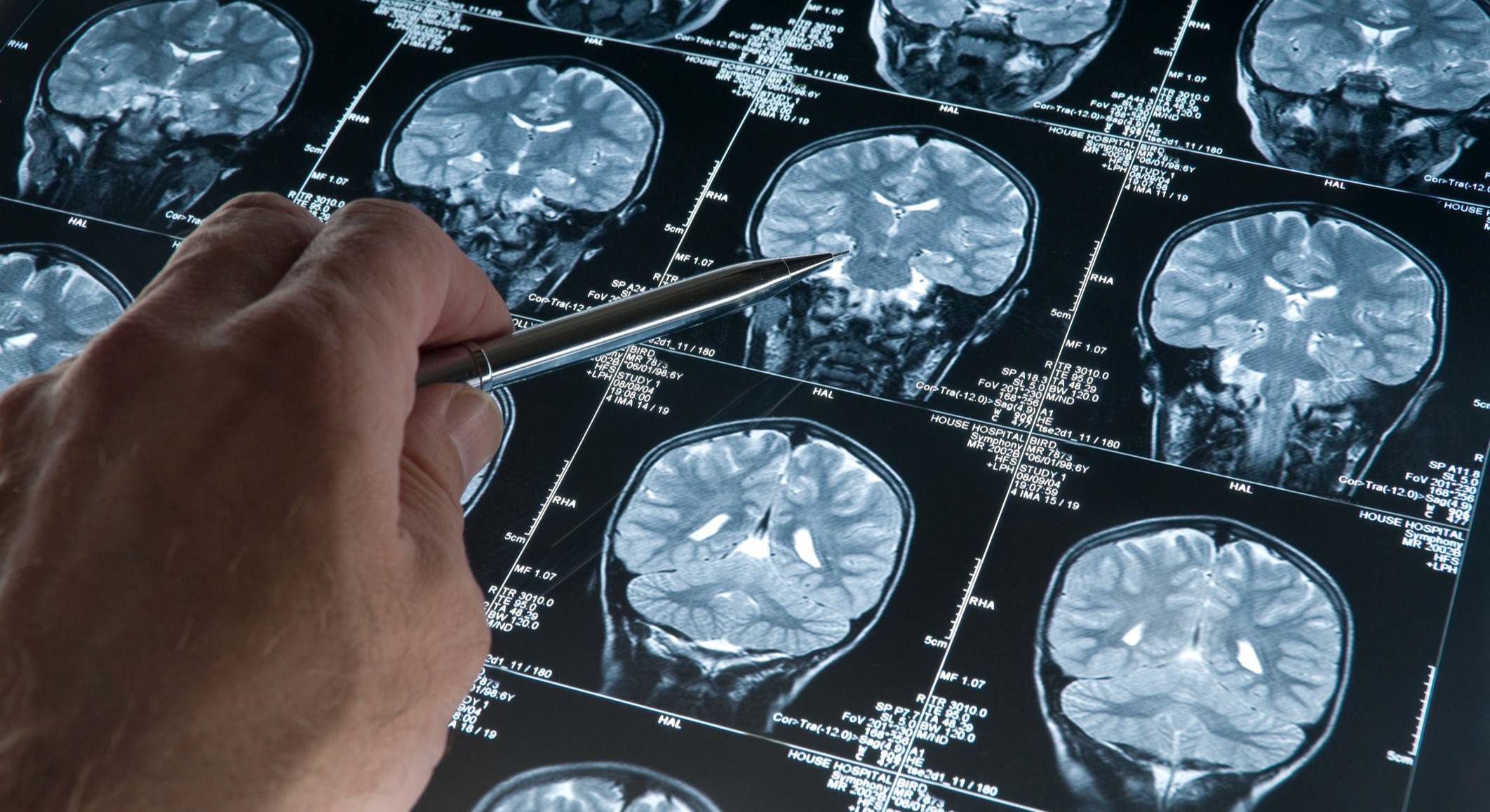 MRI, tomografía cerebral de la cabeza