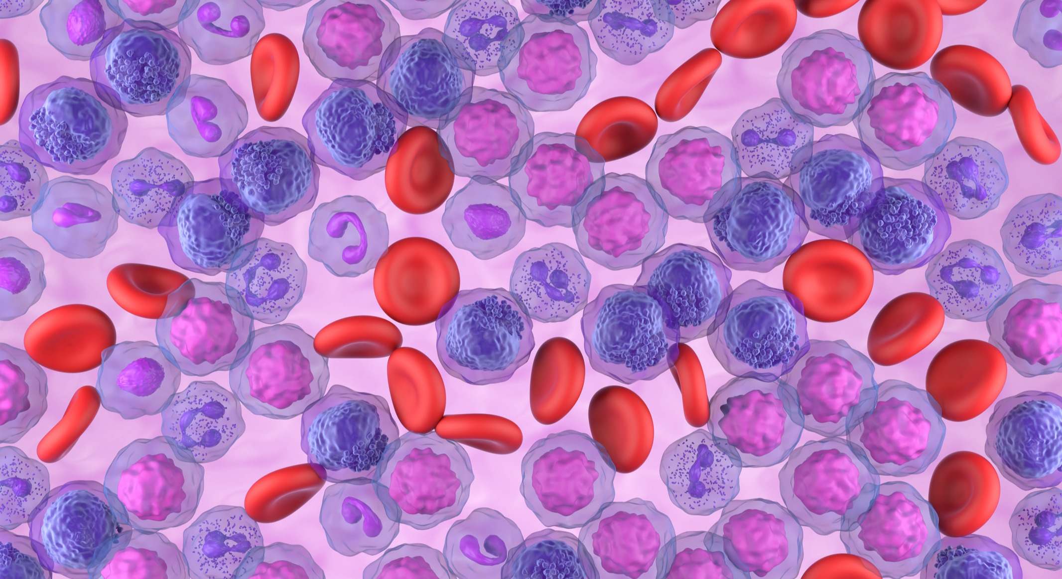 Células de leucemia mieloide aguda (LMA) en el flujo sanguíneo