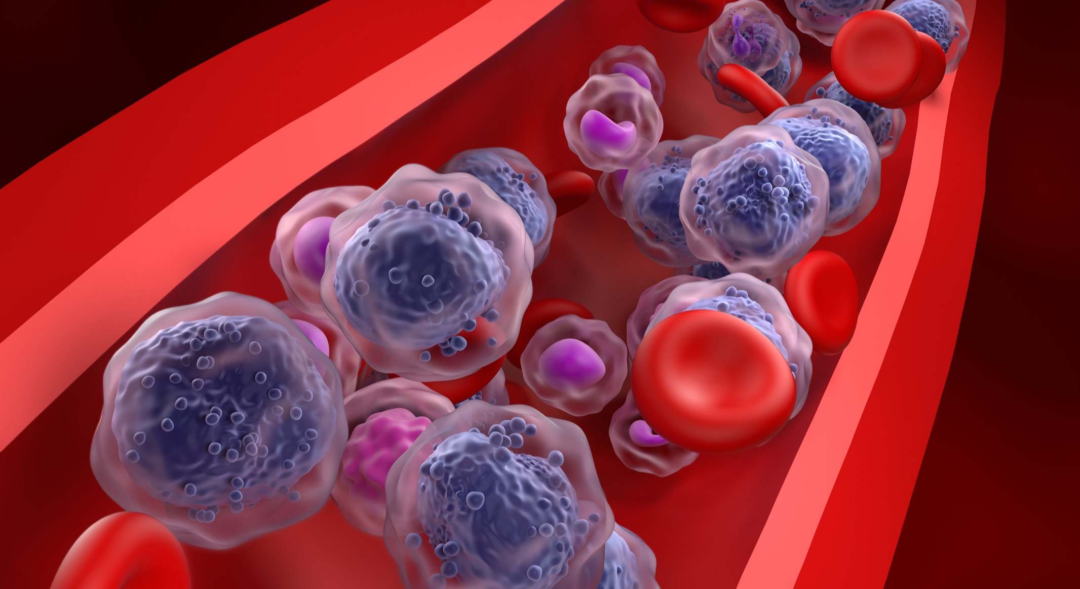 Leucemia mieloide aguda Células de LMA en el flujo sanguíneo