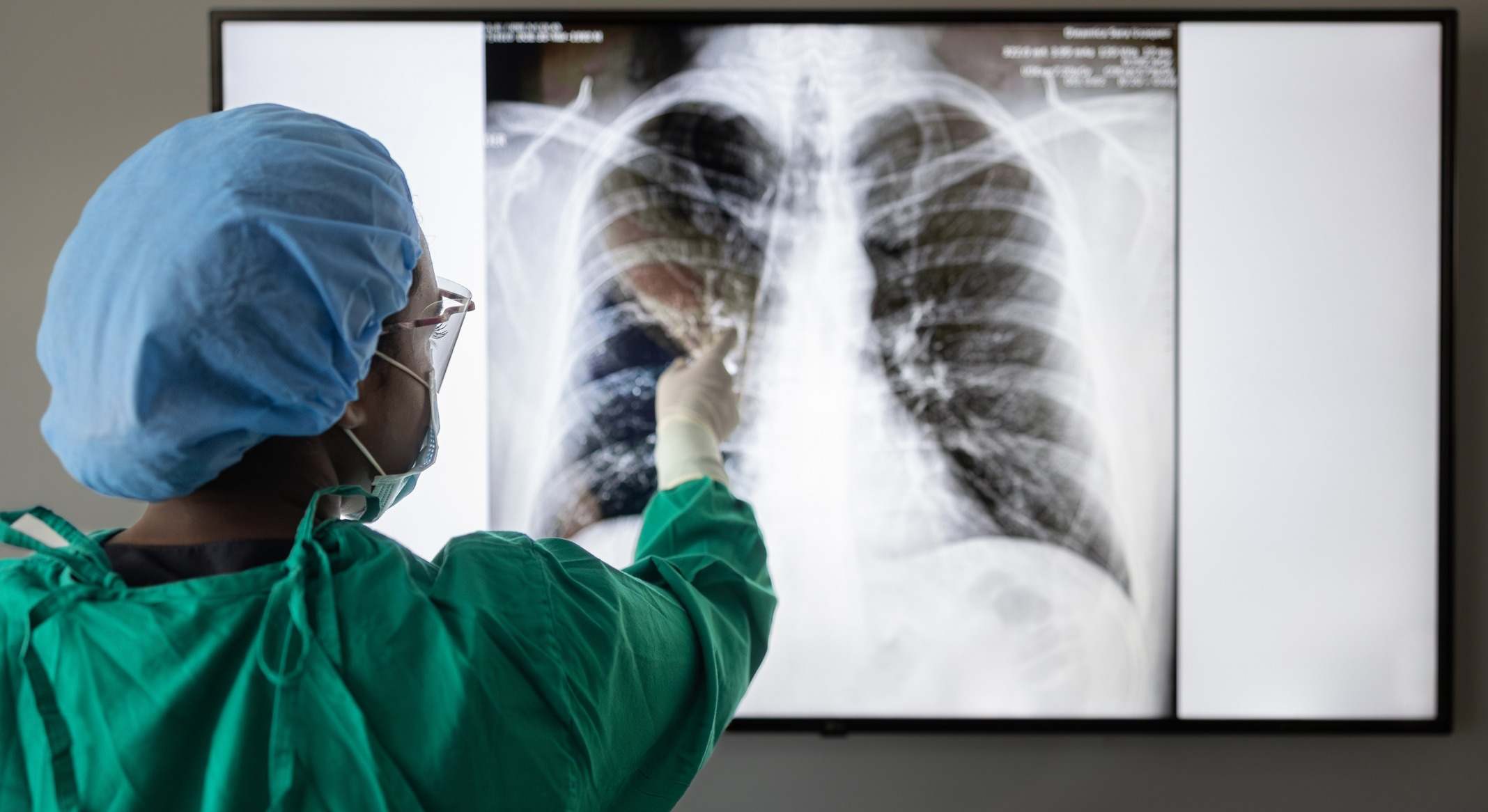 Médico señalando una radiografía de unos pulmones
