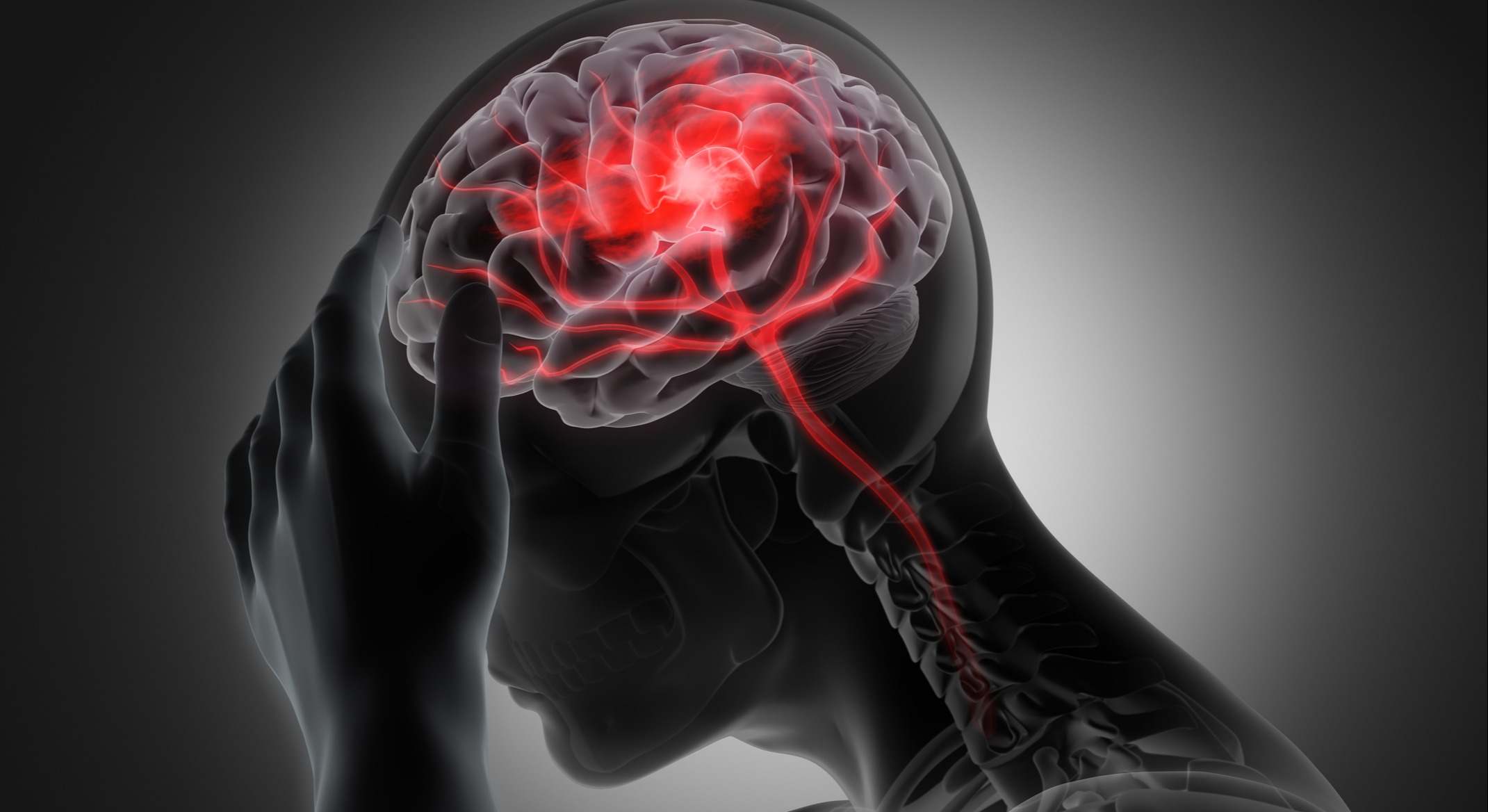 Ilustración 3D de una accidente cerebrovascular