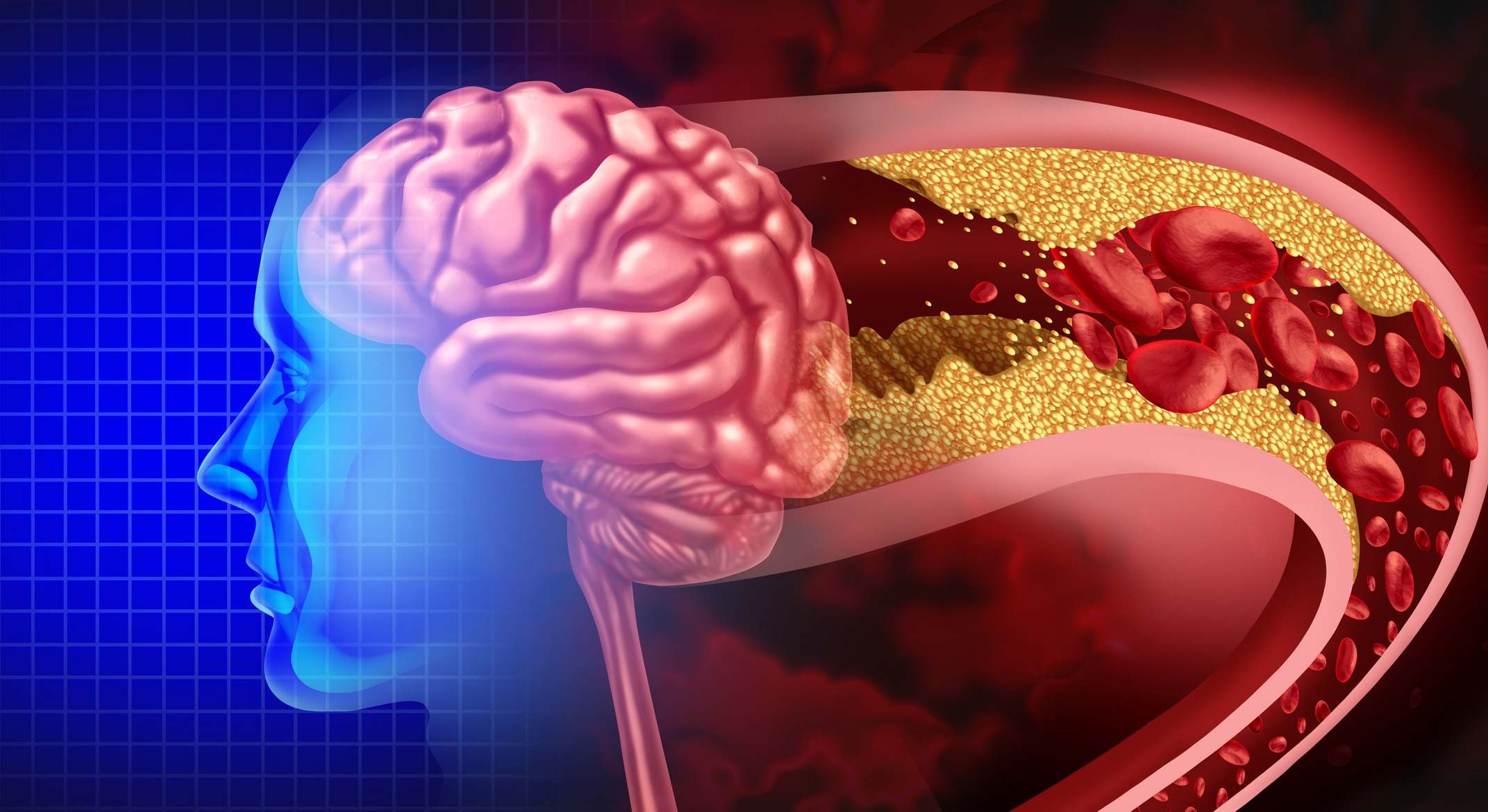 Ataque de accidente cerebrovascular