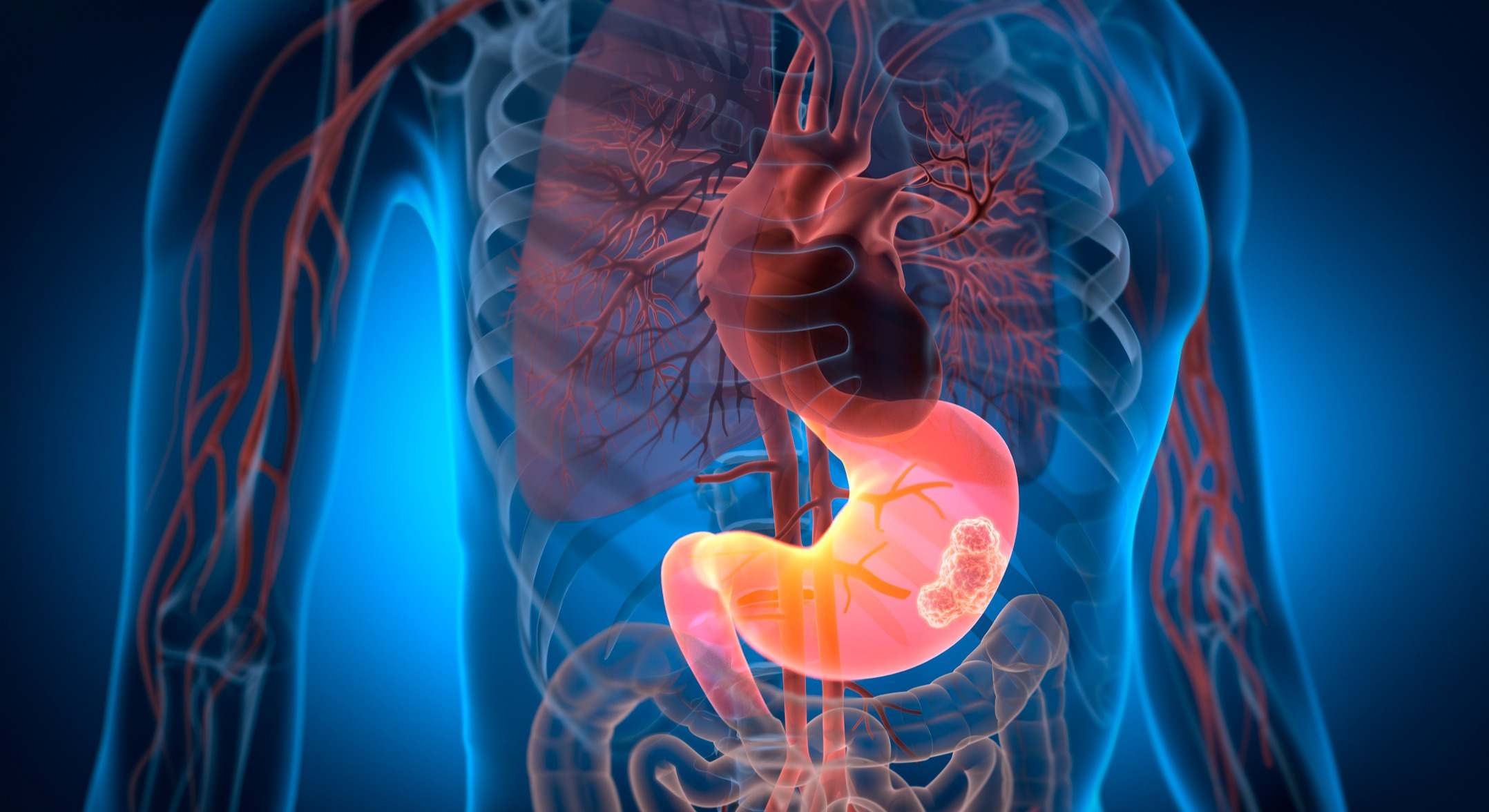 Imagen de tumor gástrico