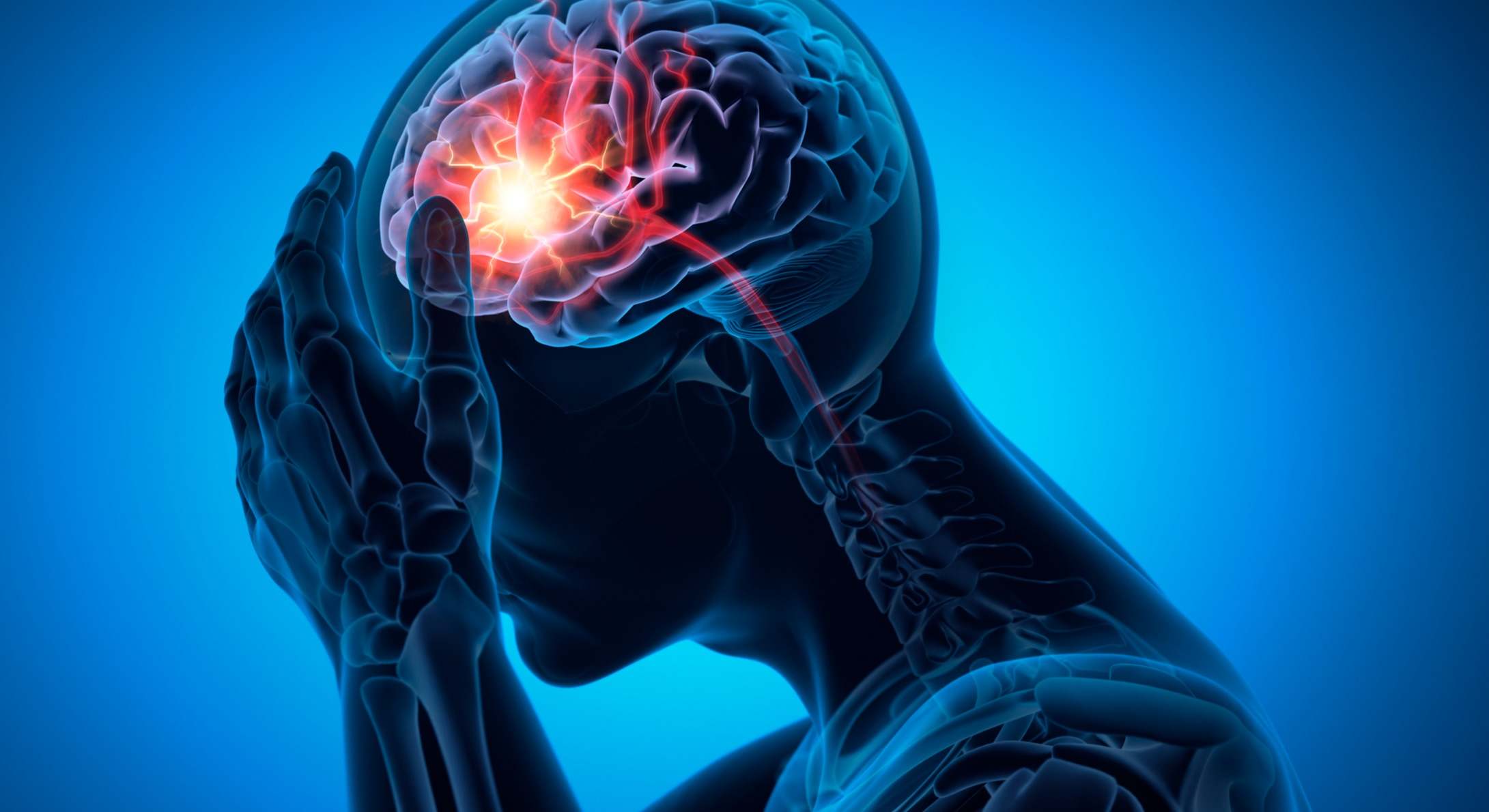 Ilustración de un infarto cerebral
