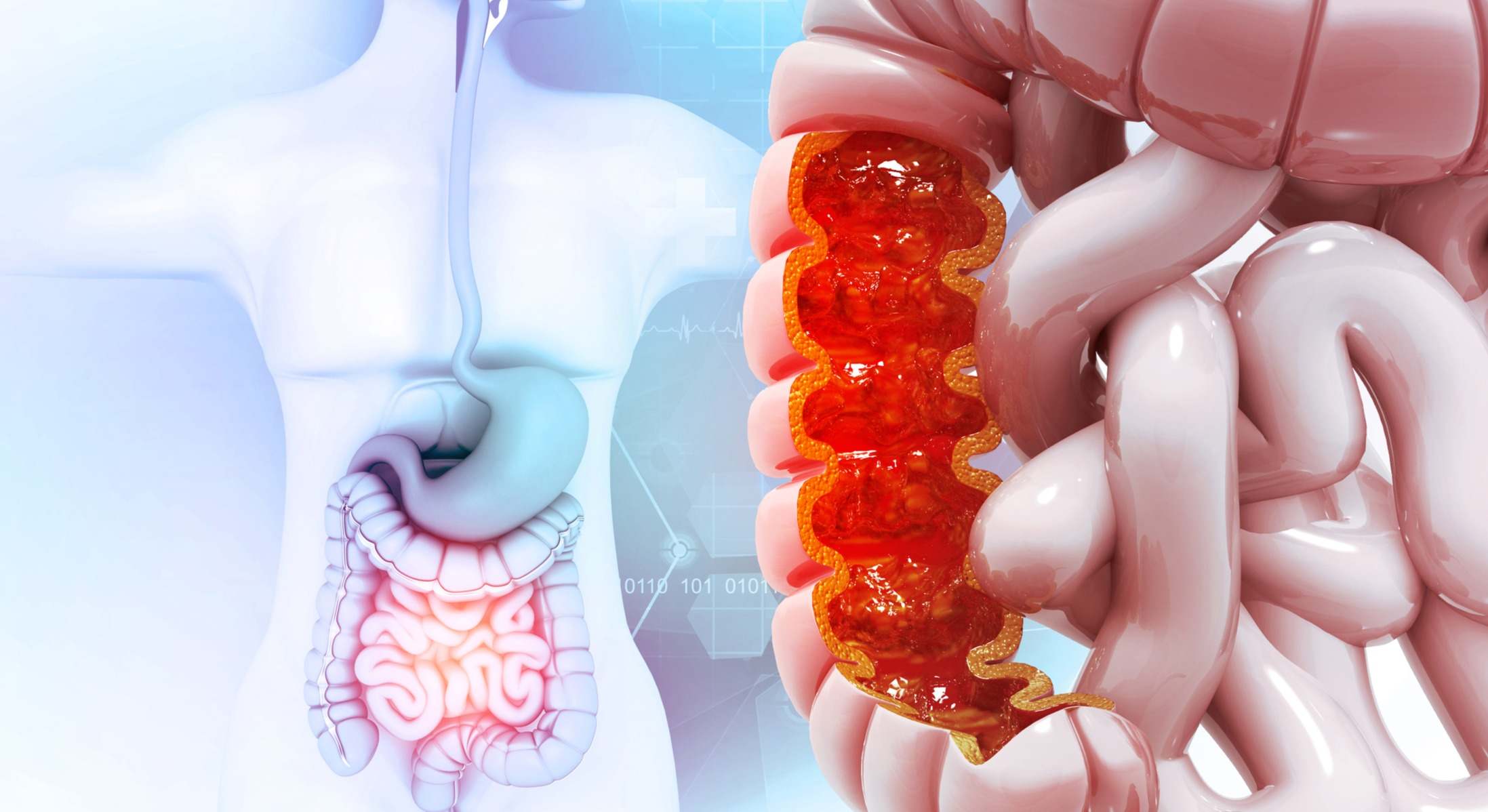 Divertículos en el colon