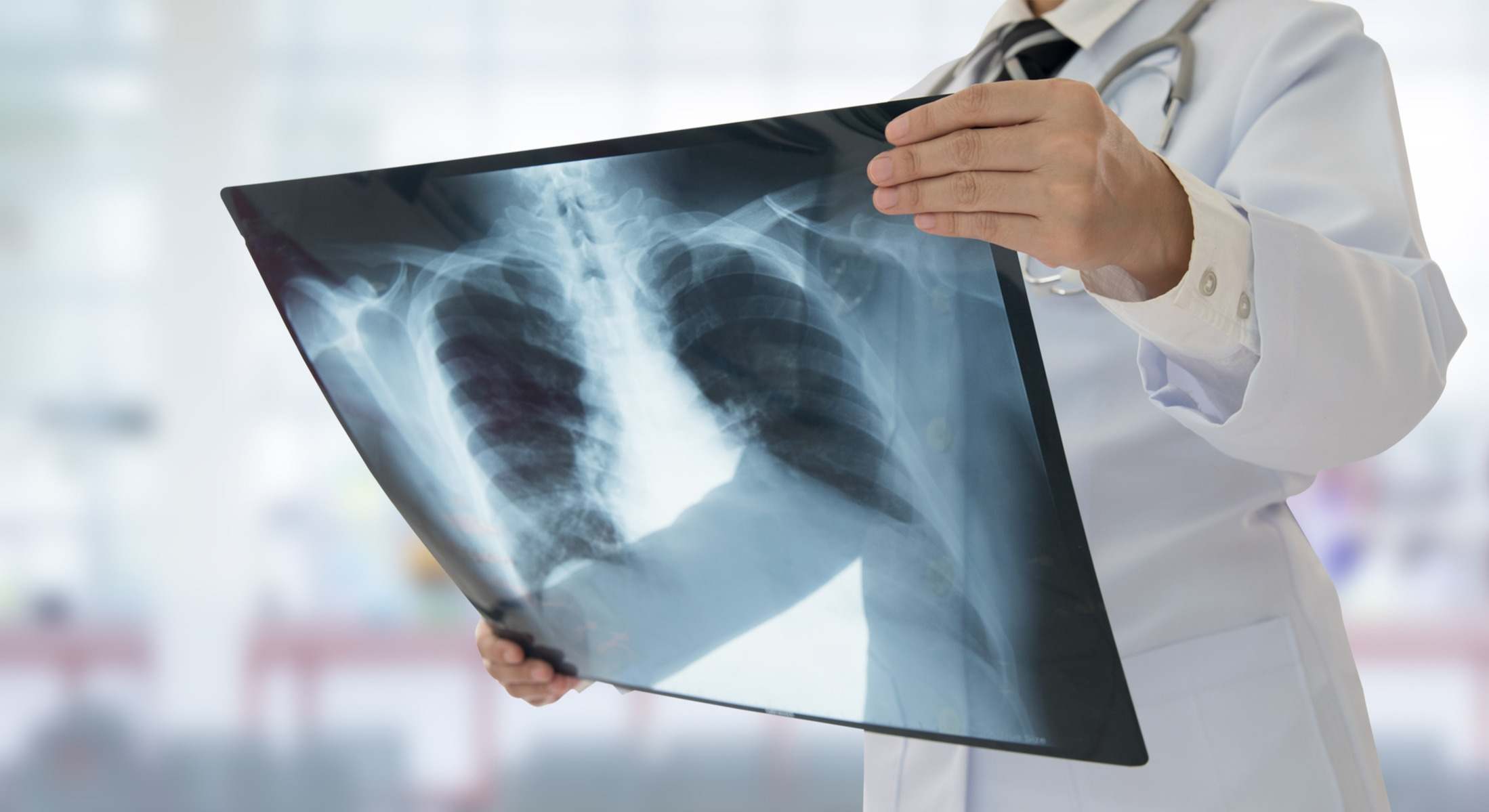 Médico sujetando una radiografía de unos pulmones