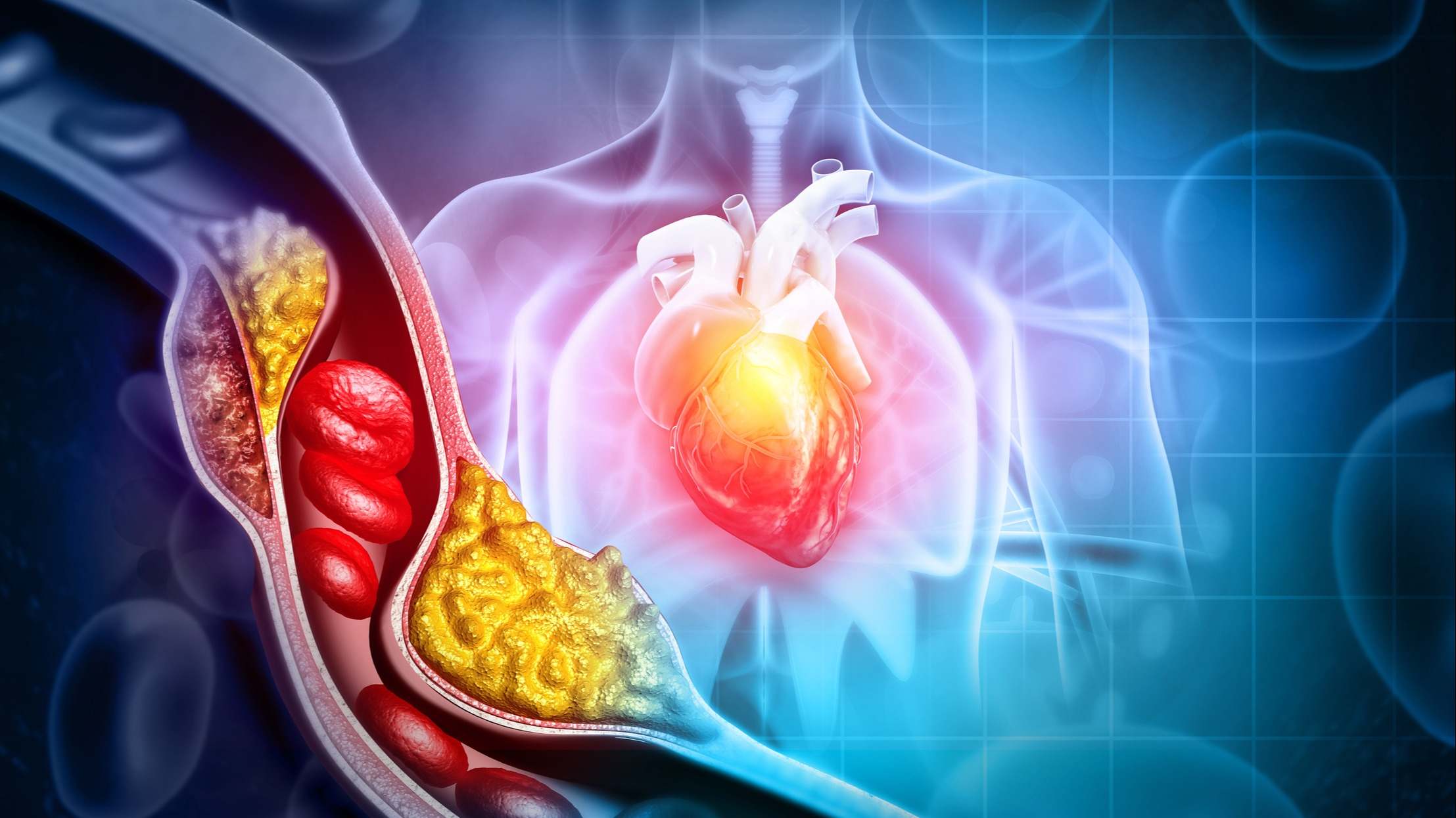 Ilustración 3D del colesterol bloqueando una arteria con un corazón de fondo