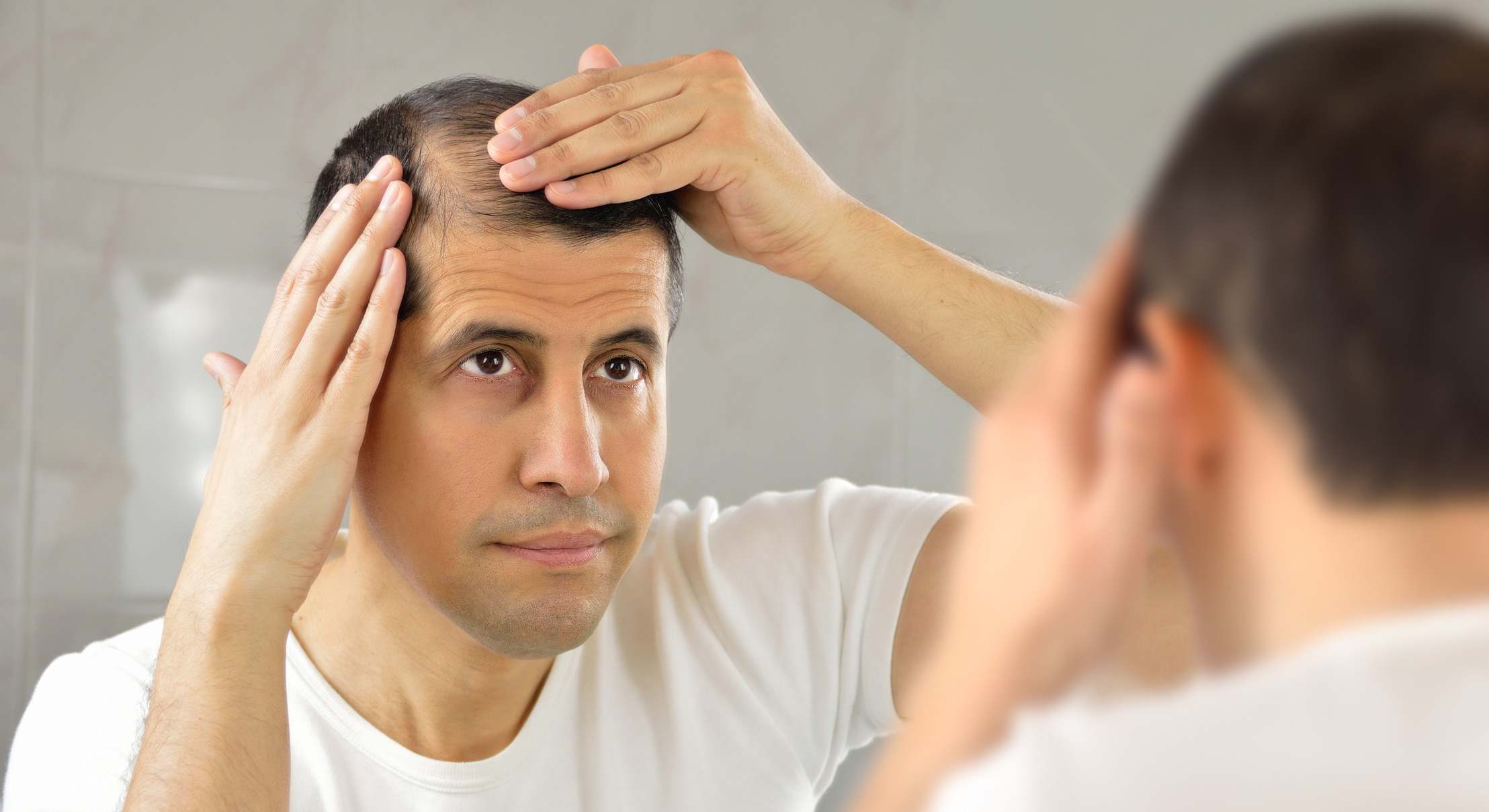 Hombre con problemas de calvicie