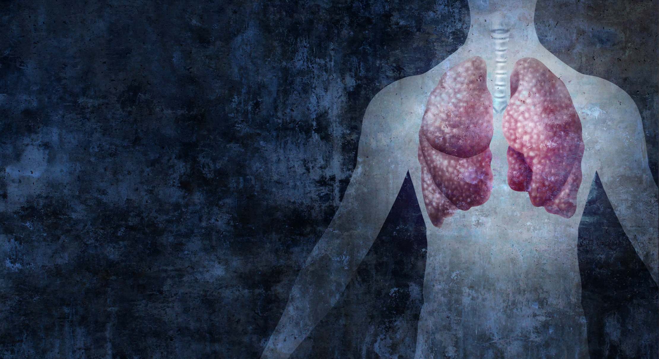 bronquiolitis