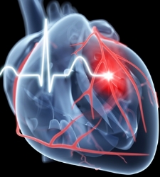 infarto-getty.jpg