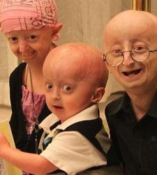 progeria-revistanature.jpg