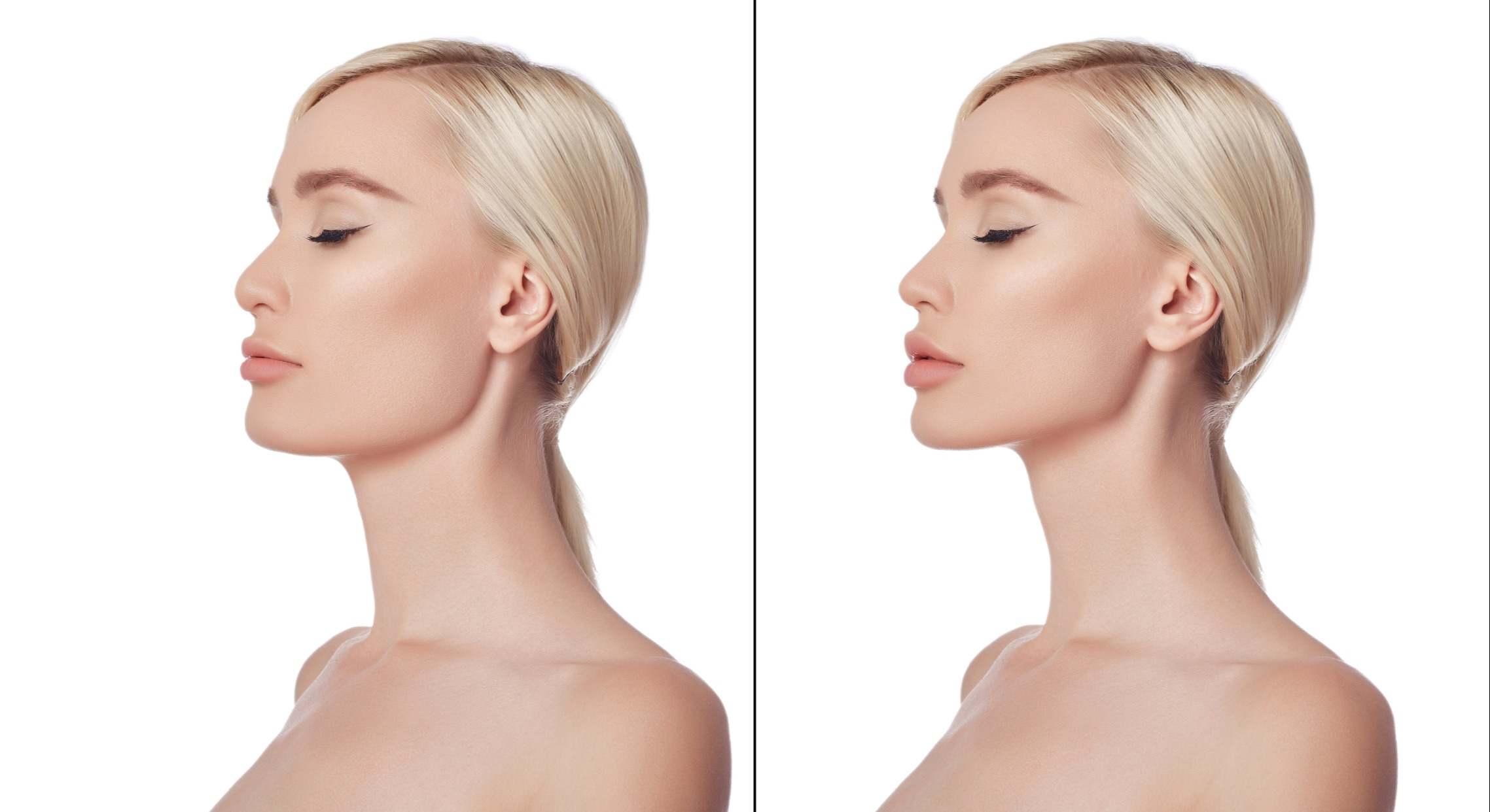 Dos fotos de la misma mujer con la diferencia de tener la barbilla más marcada en la derecha