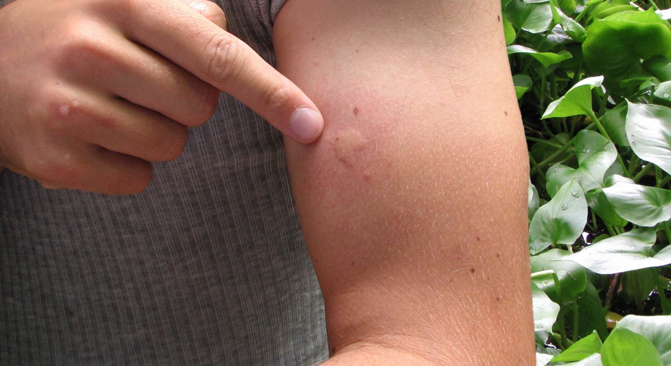 Picadura de un mosquito en el brazo