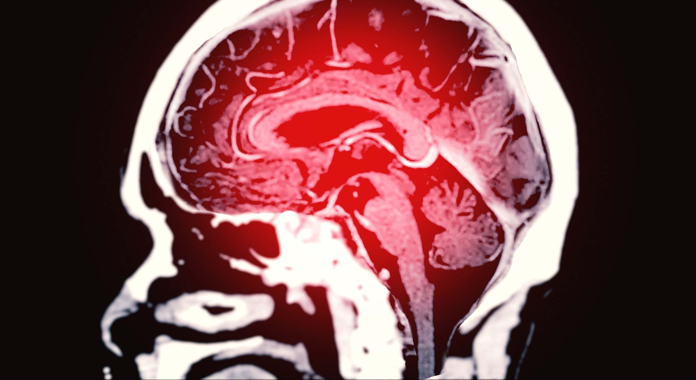 Tomografía computarizada del plano sagital cerebral para el diagnóstico de tumor cerebral, enfermedades por accidente cerebrovascular y enfermedades vasculares