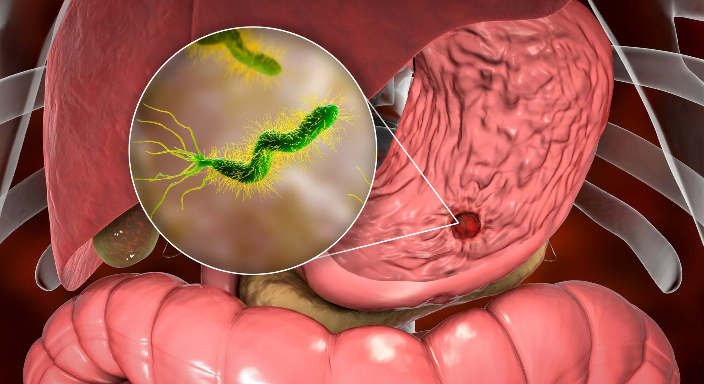 Bacteria Helicobacter Pylori en el estómago