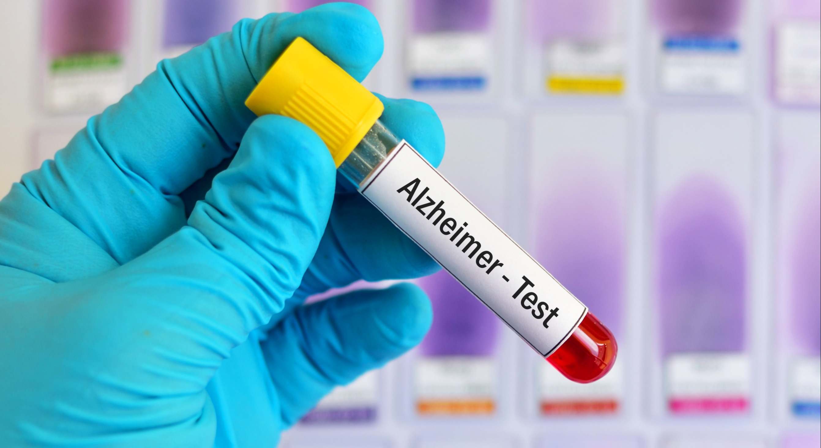 Muestra de sangre para la prueba de Alzheimer