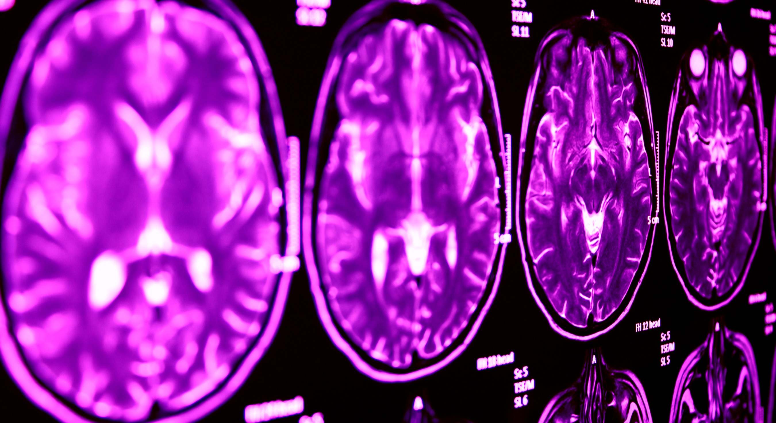 Resonancia magnética del cerebro