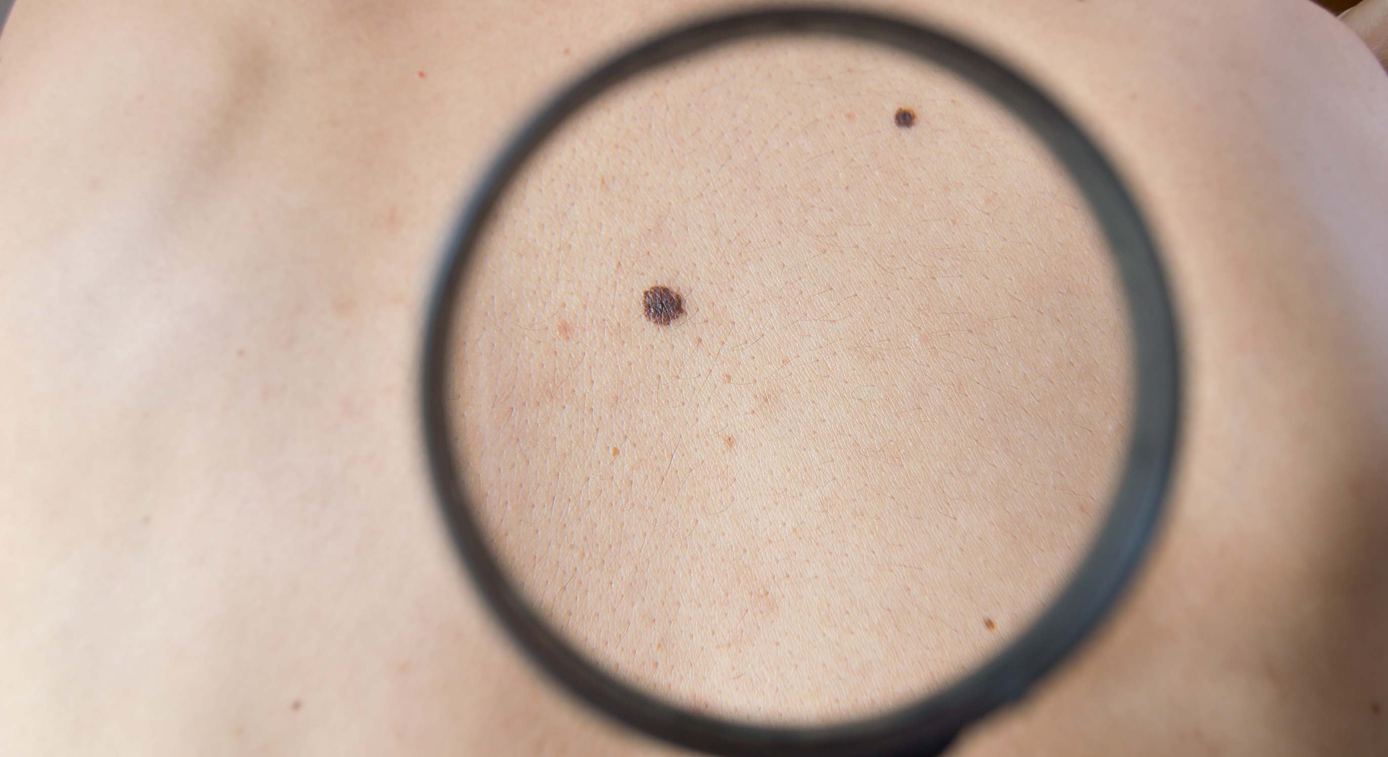 Detección precoz del melanoma: todo lo que necesitas saber
