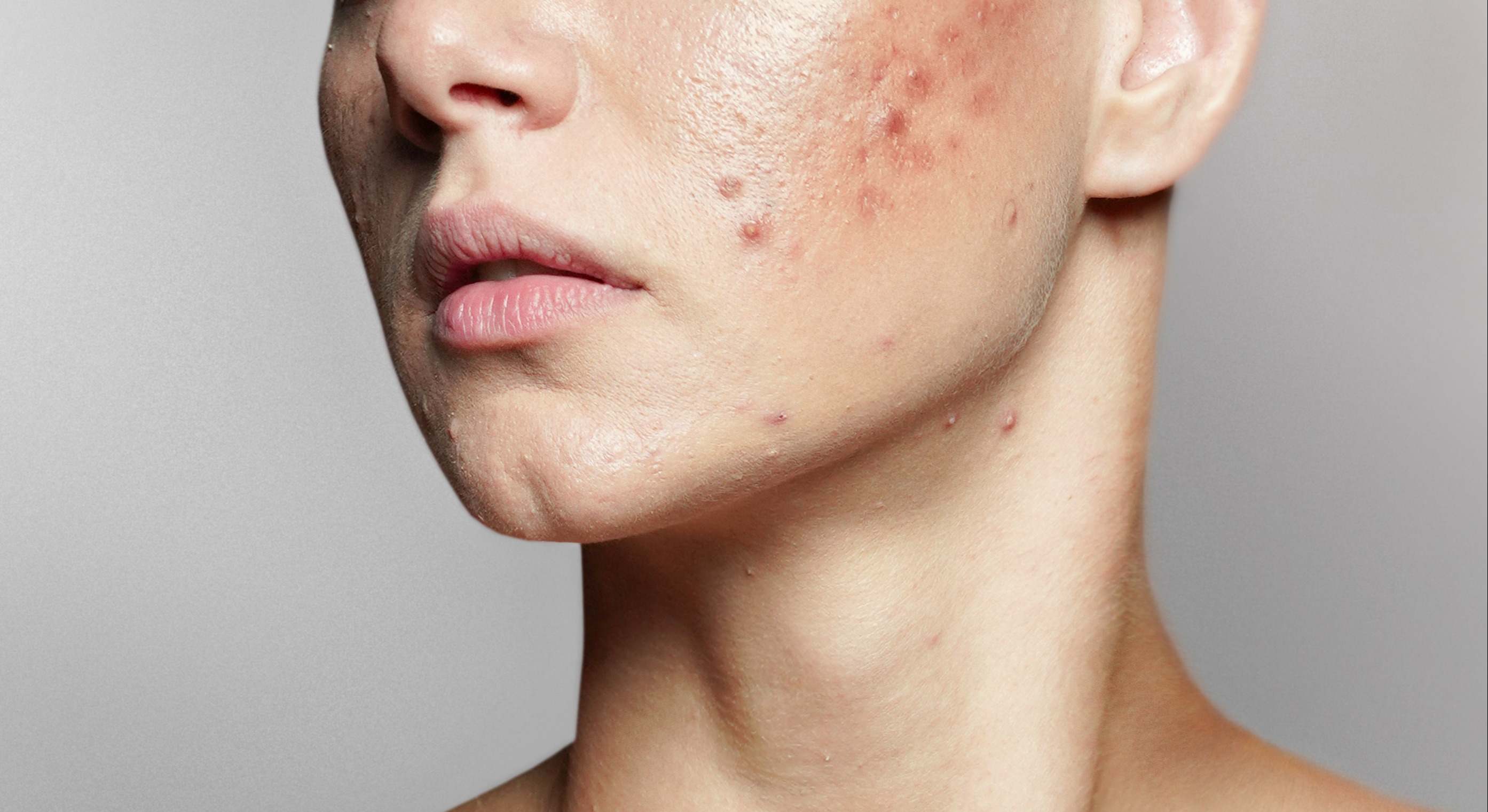 Acne | Firma: iStock