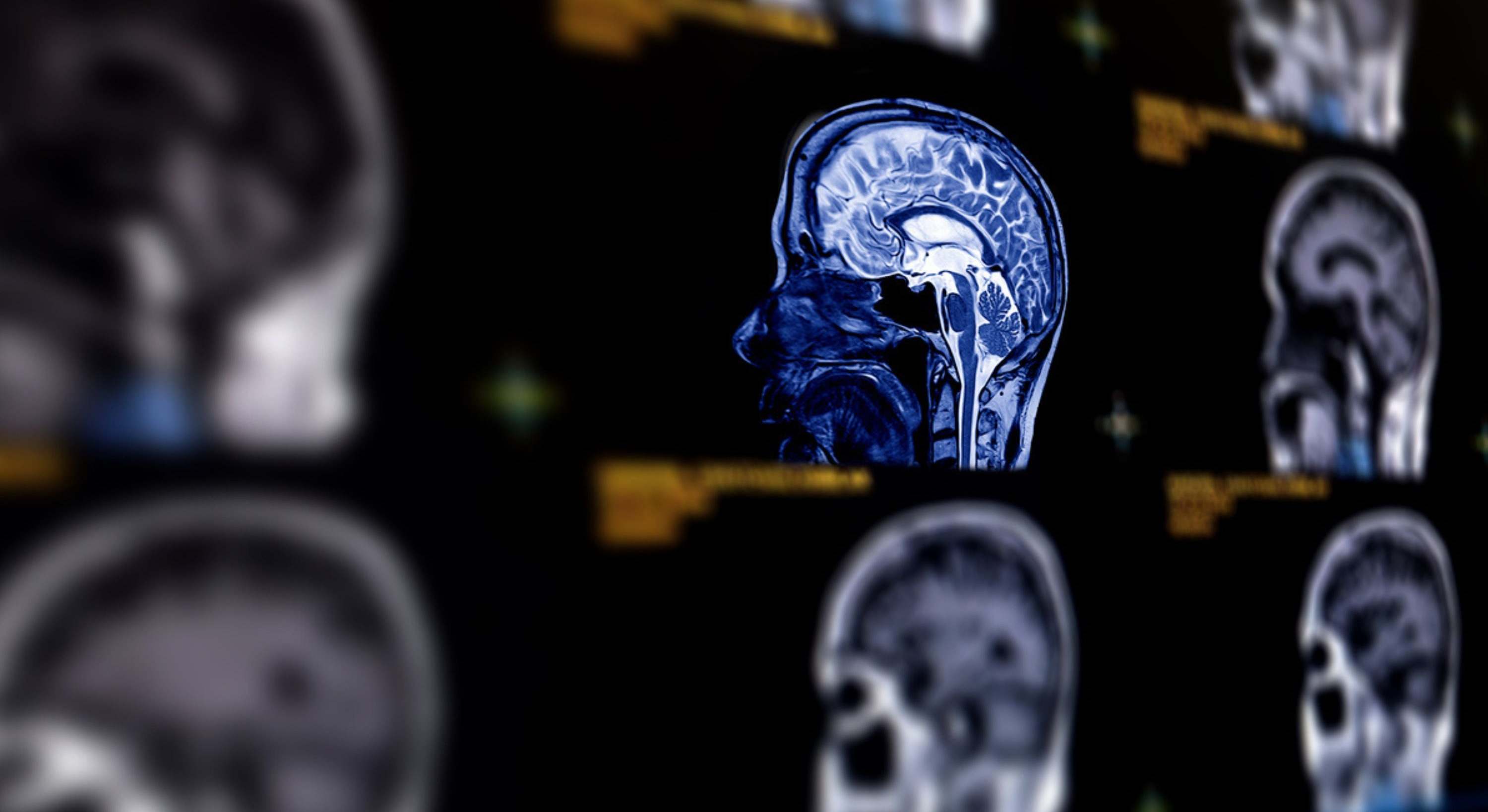 Descubre en este artículo cómo identificar un aneurisma cerebral y cuál es su tratamiento.