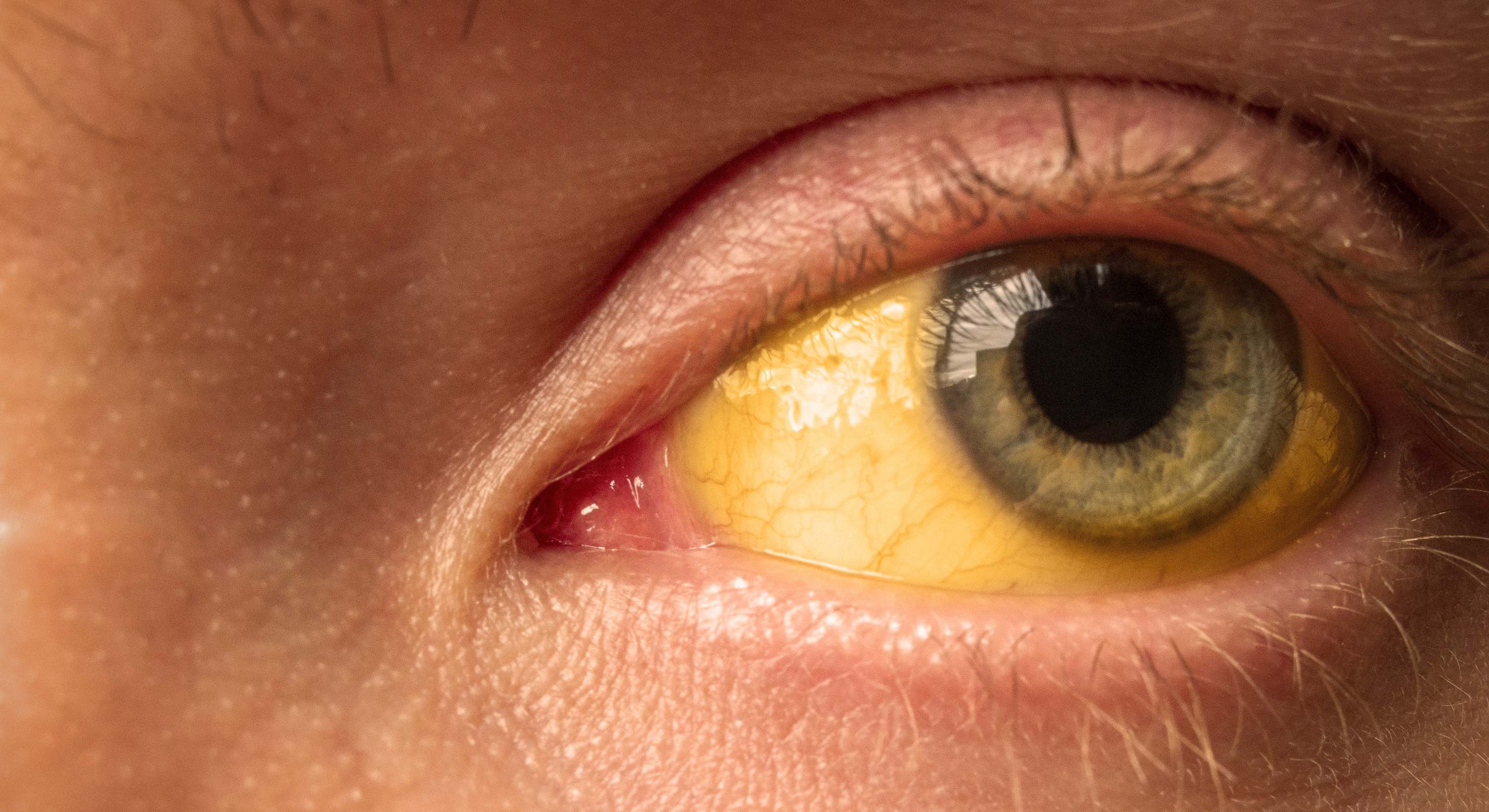 ojos amarillentos a causa de ictericia