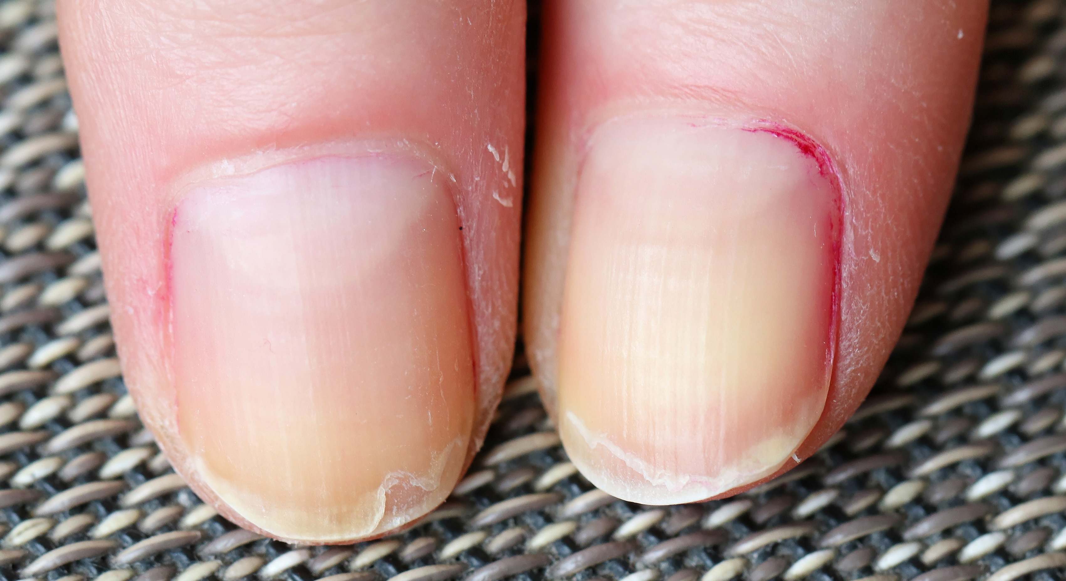 Las uñas de dos dedos