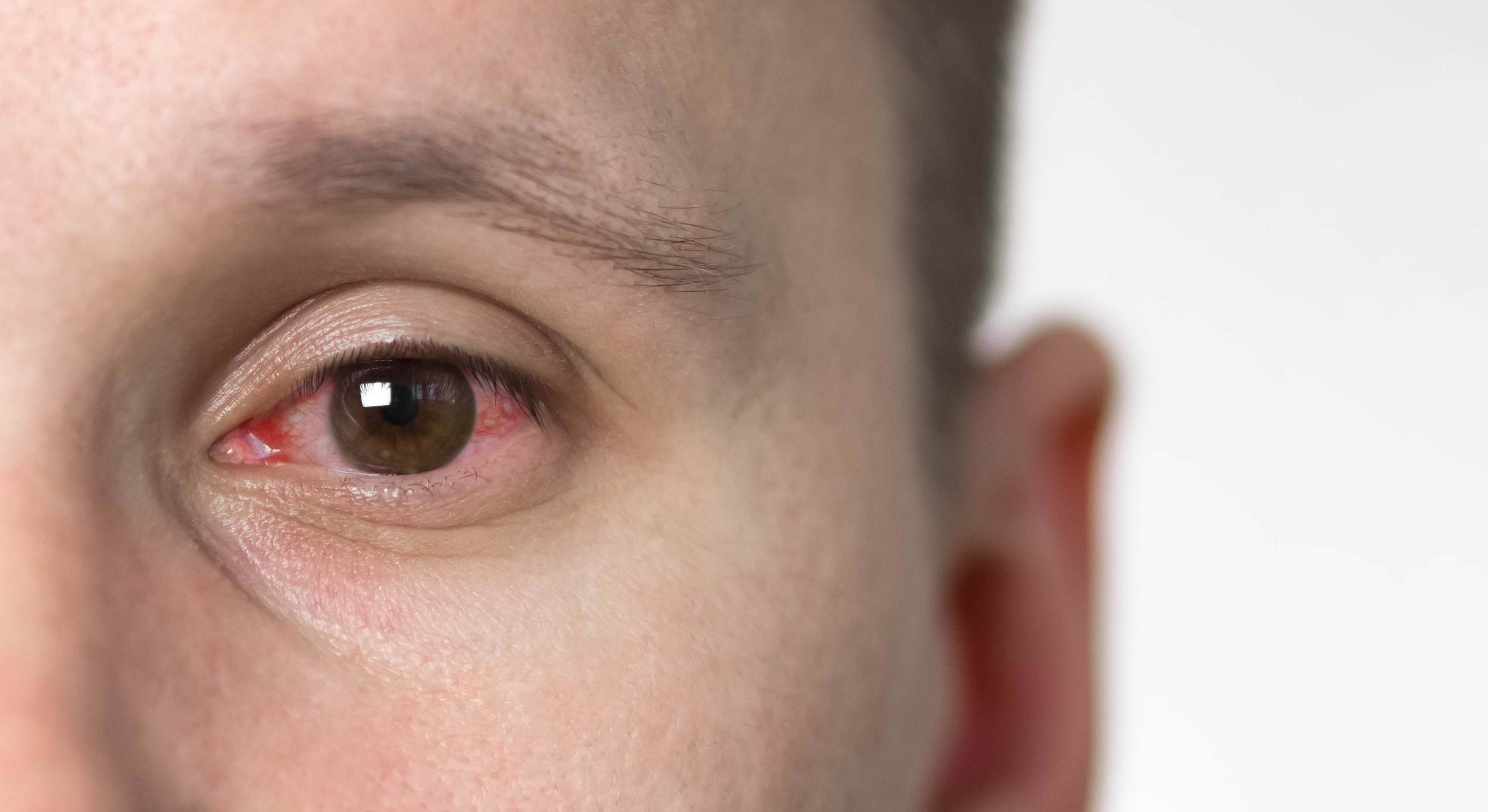 Remedios caseros para la conjuntivitis