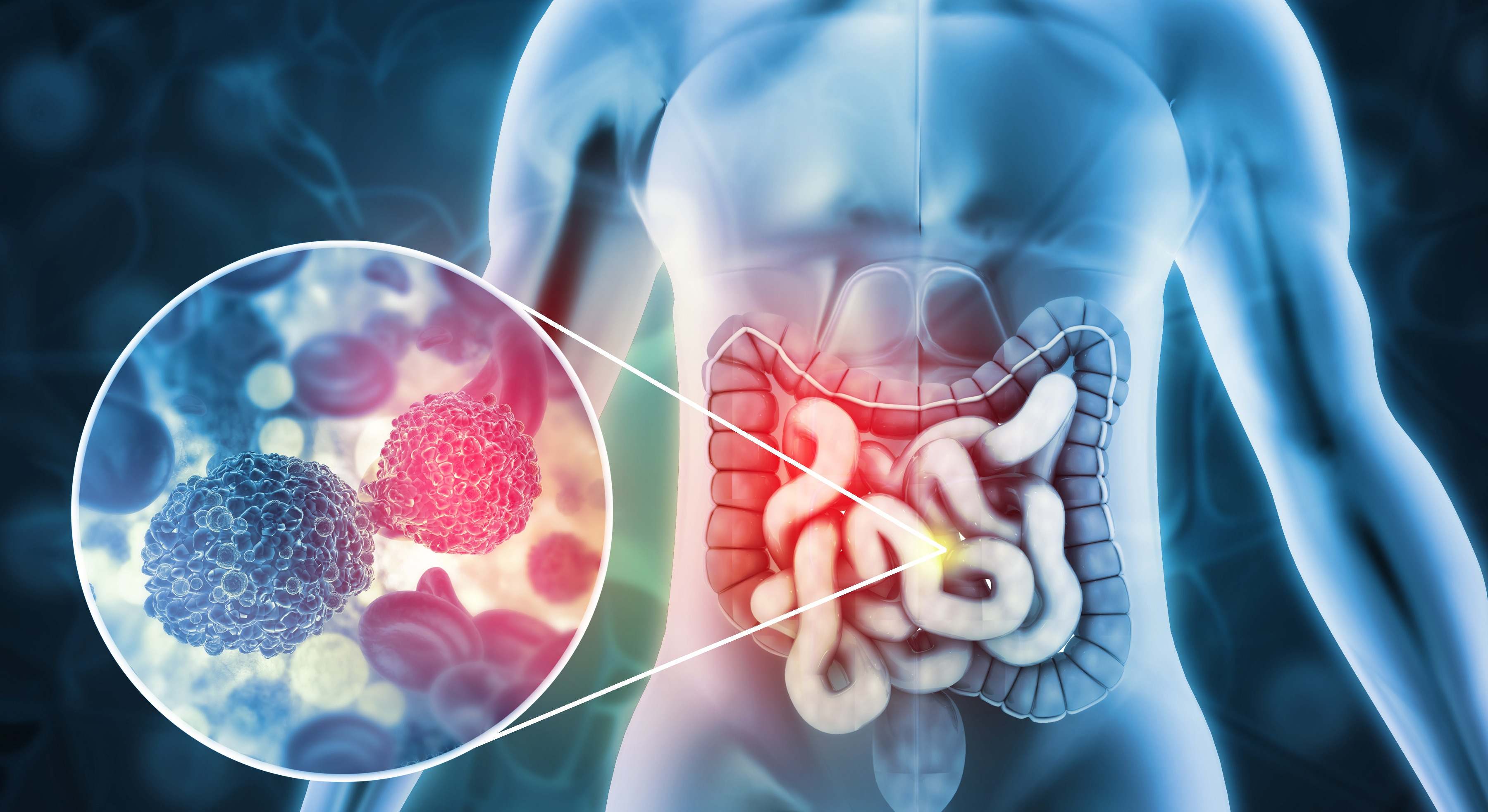 Ilustración 3D de células cancerosas en el colon