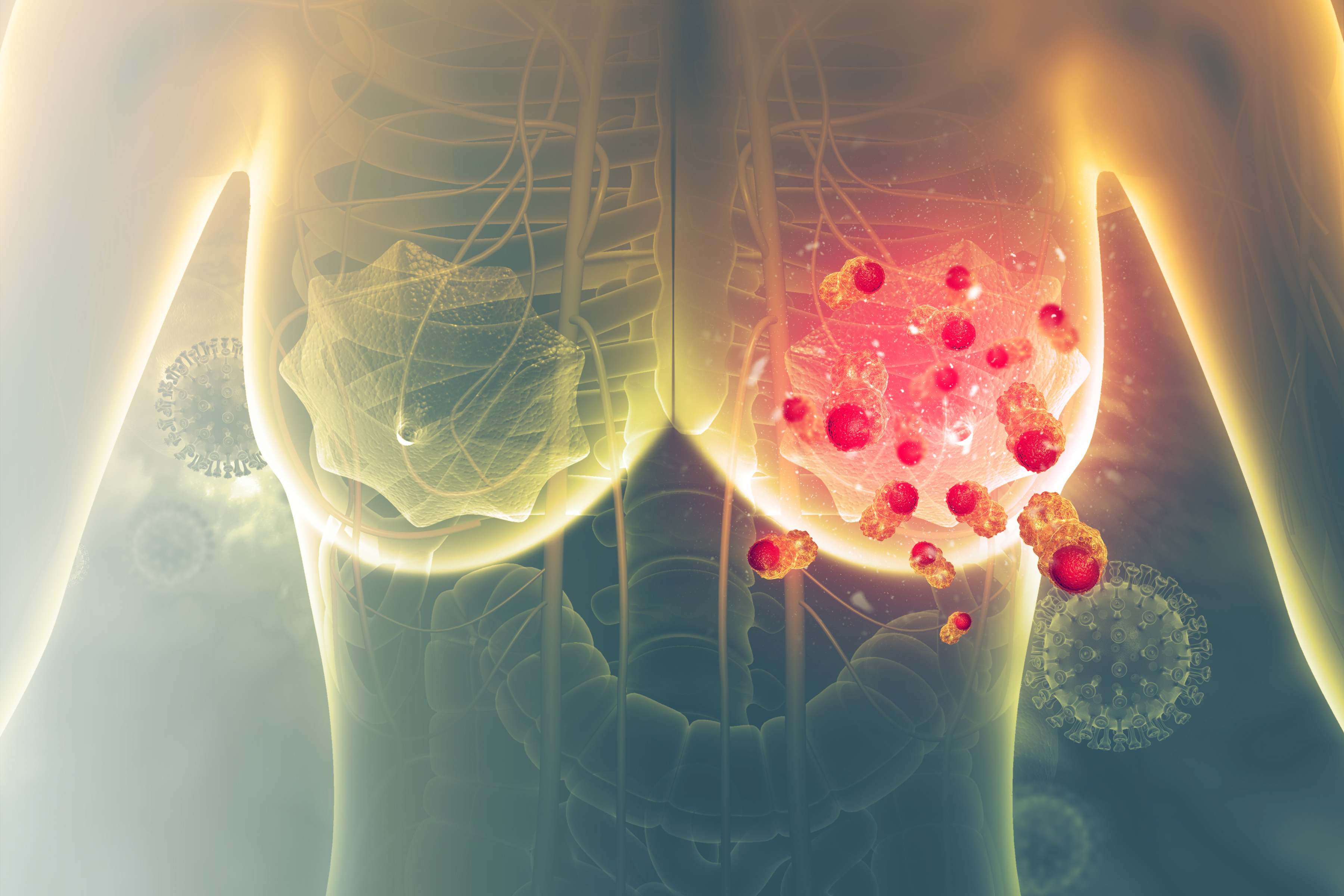 Cáncer de mama