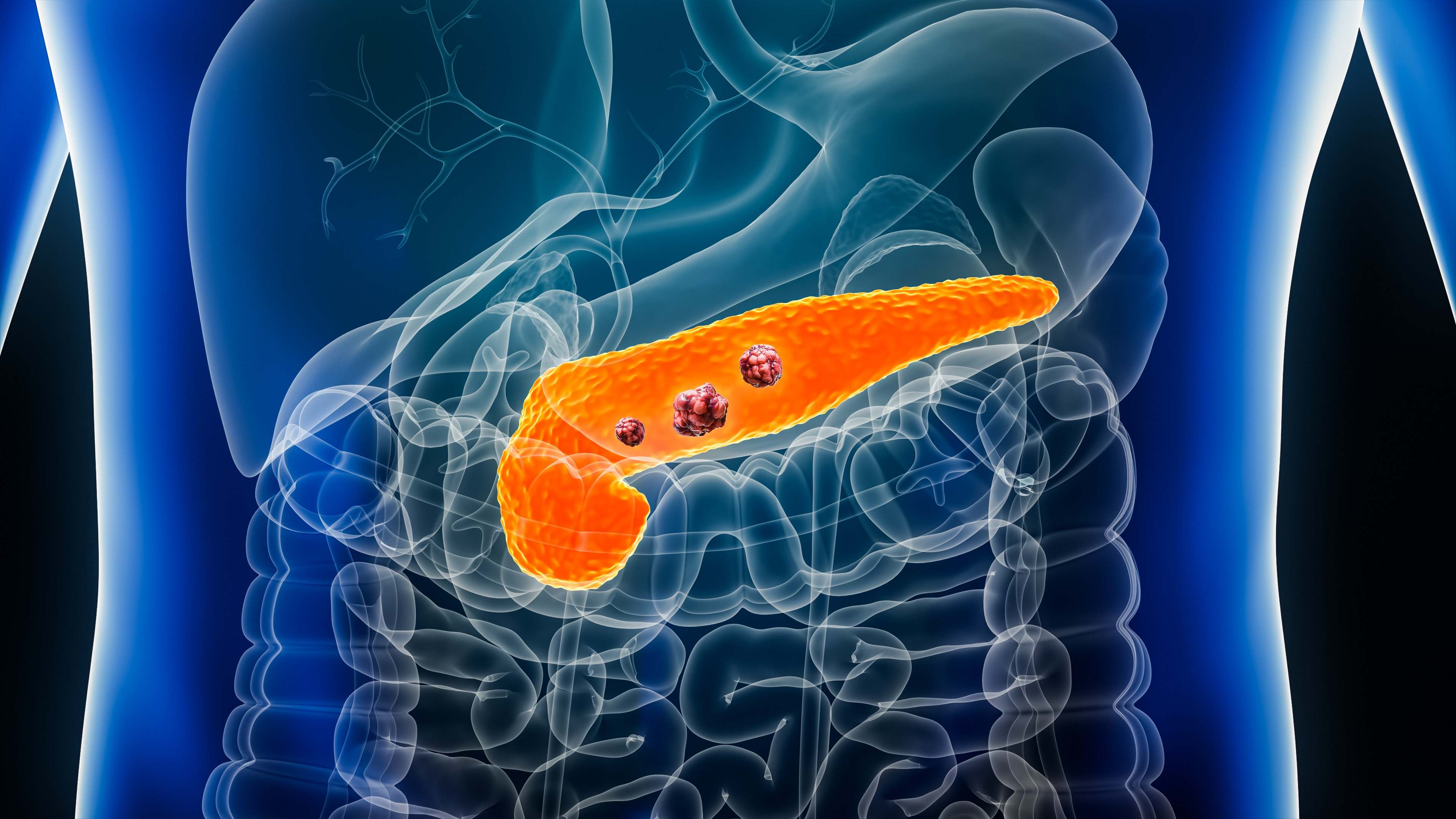 Ilustración 3D con cuerpo masculino de un cáncer de páncreas
