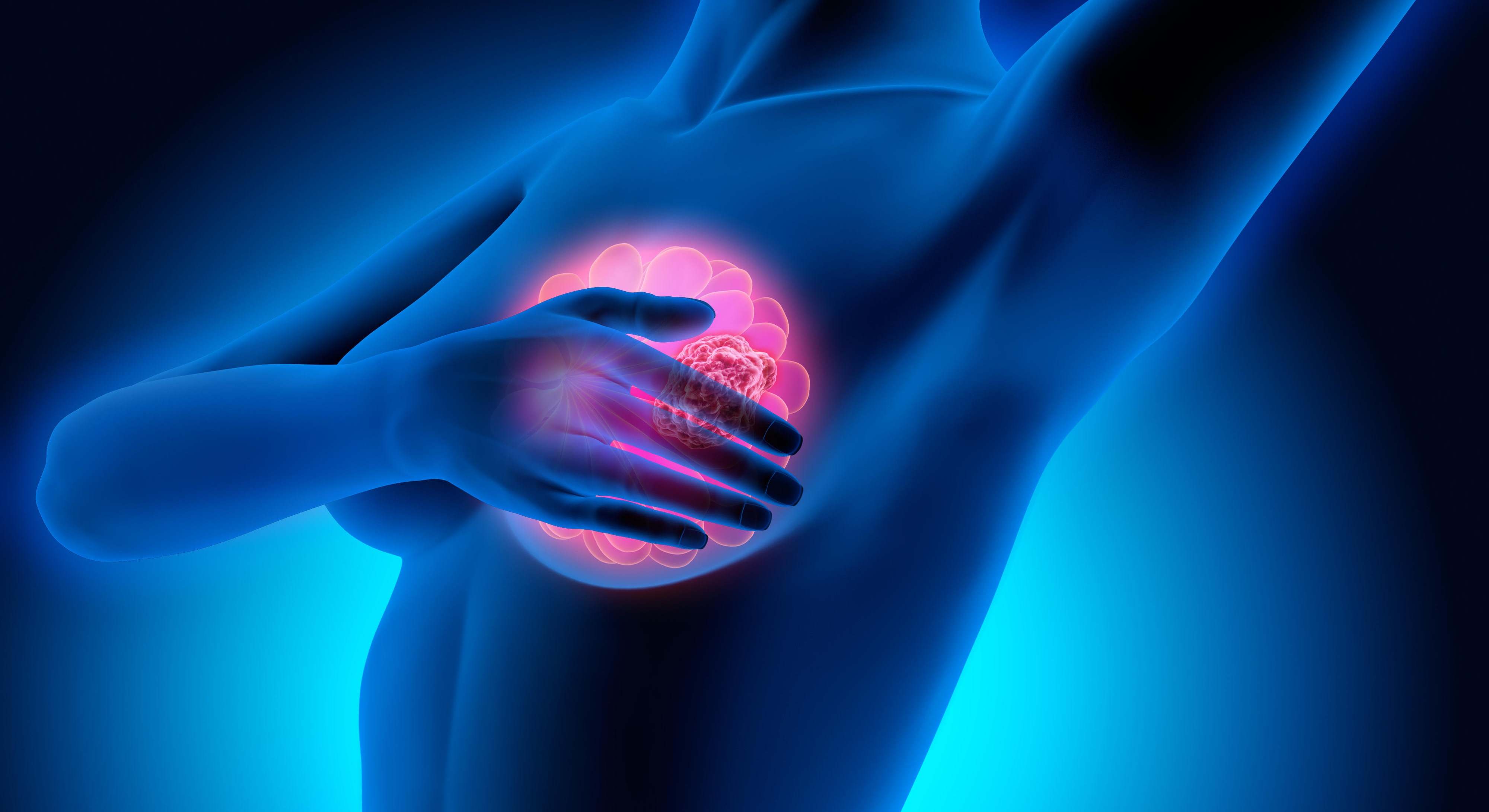 Cáncer de mama