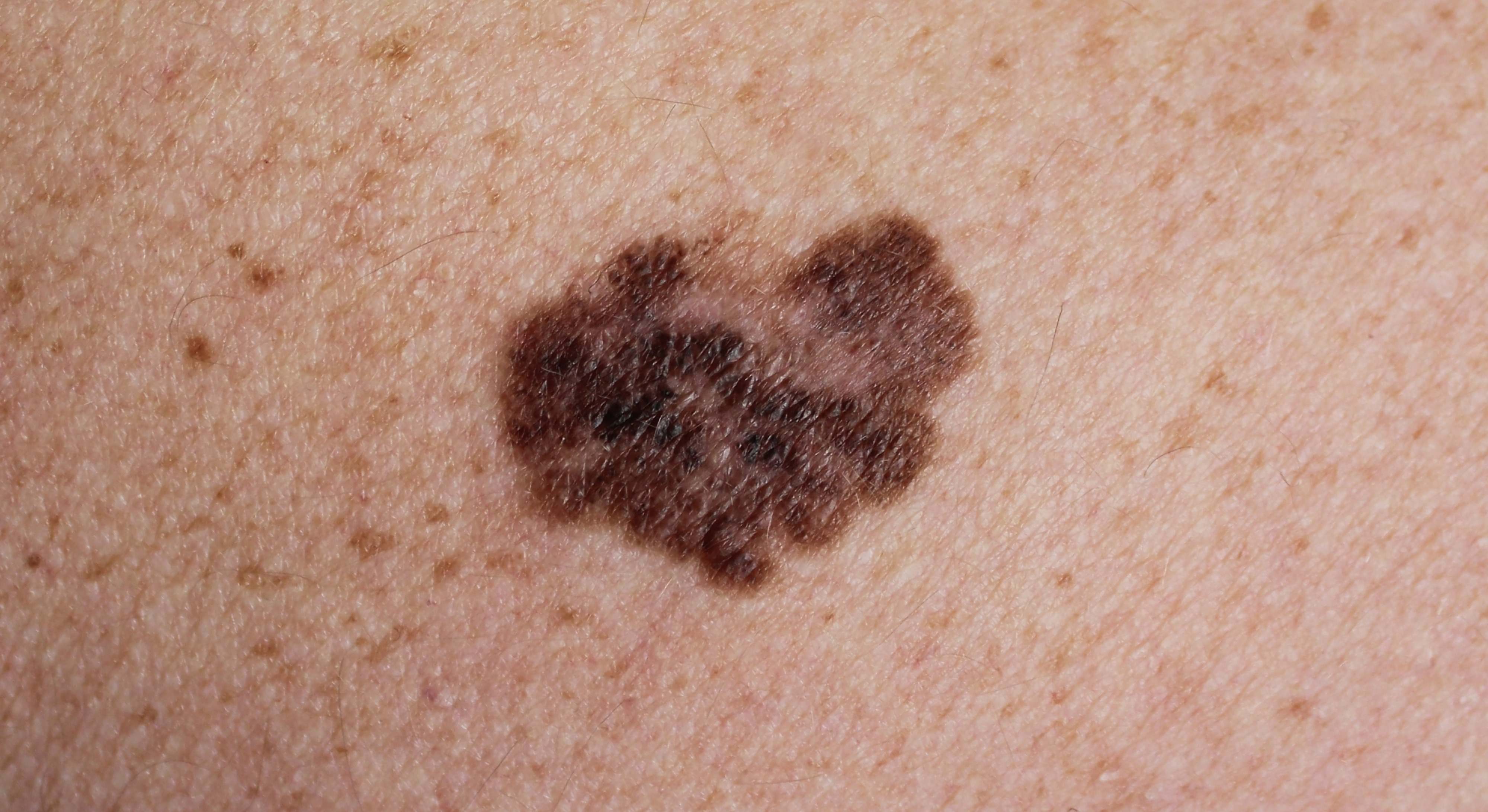 Melanoma