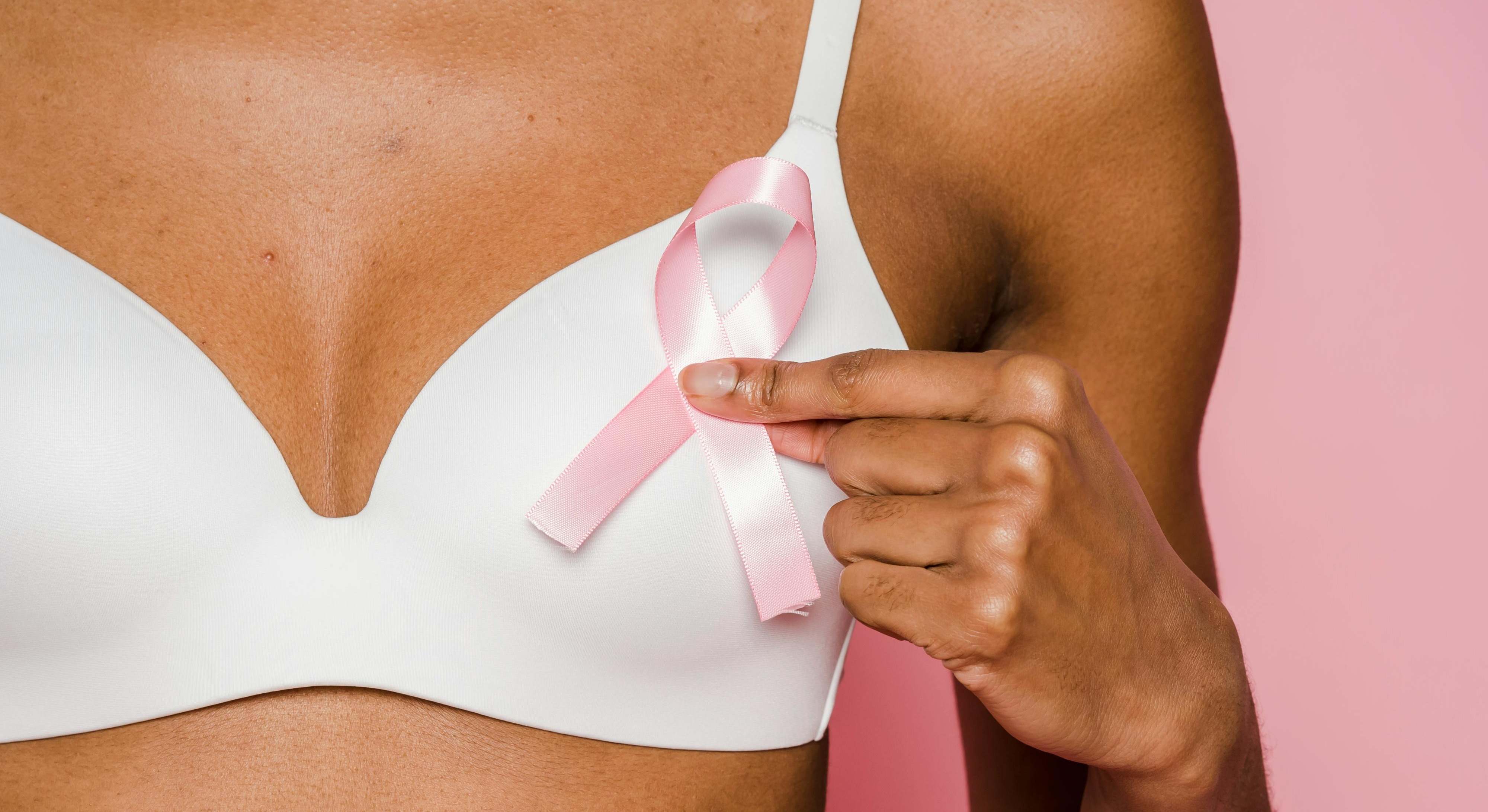 La enfermedad de Paget mamaria es una forma atípica de cáncer mamario