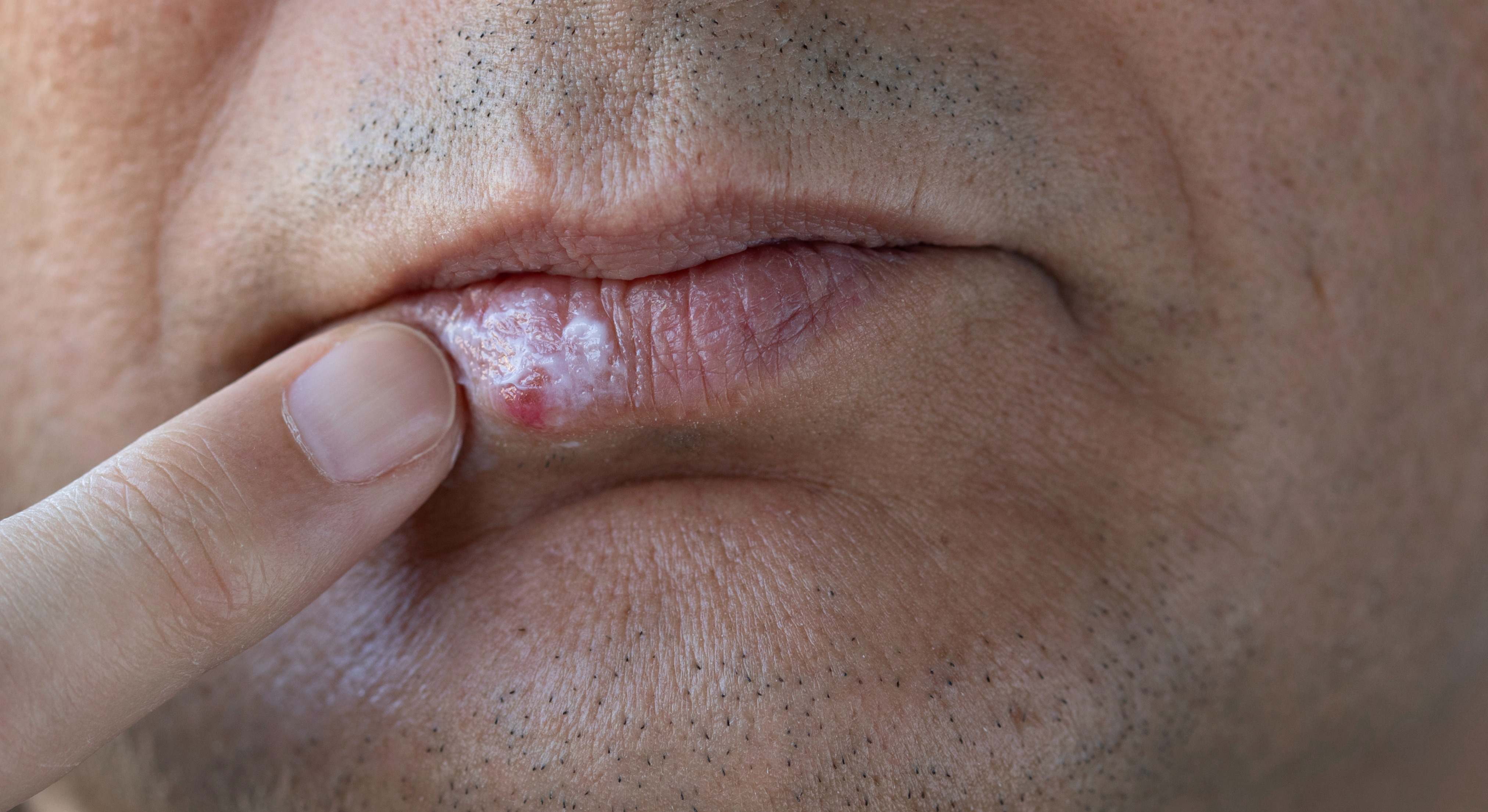 Hombre con herpes labial