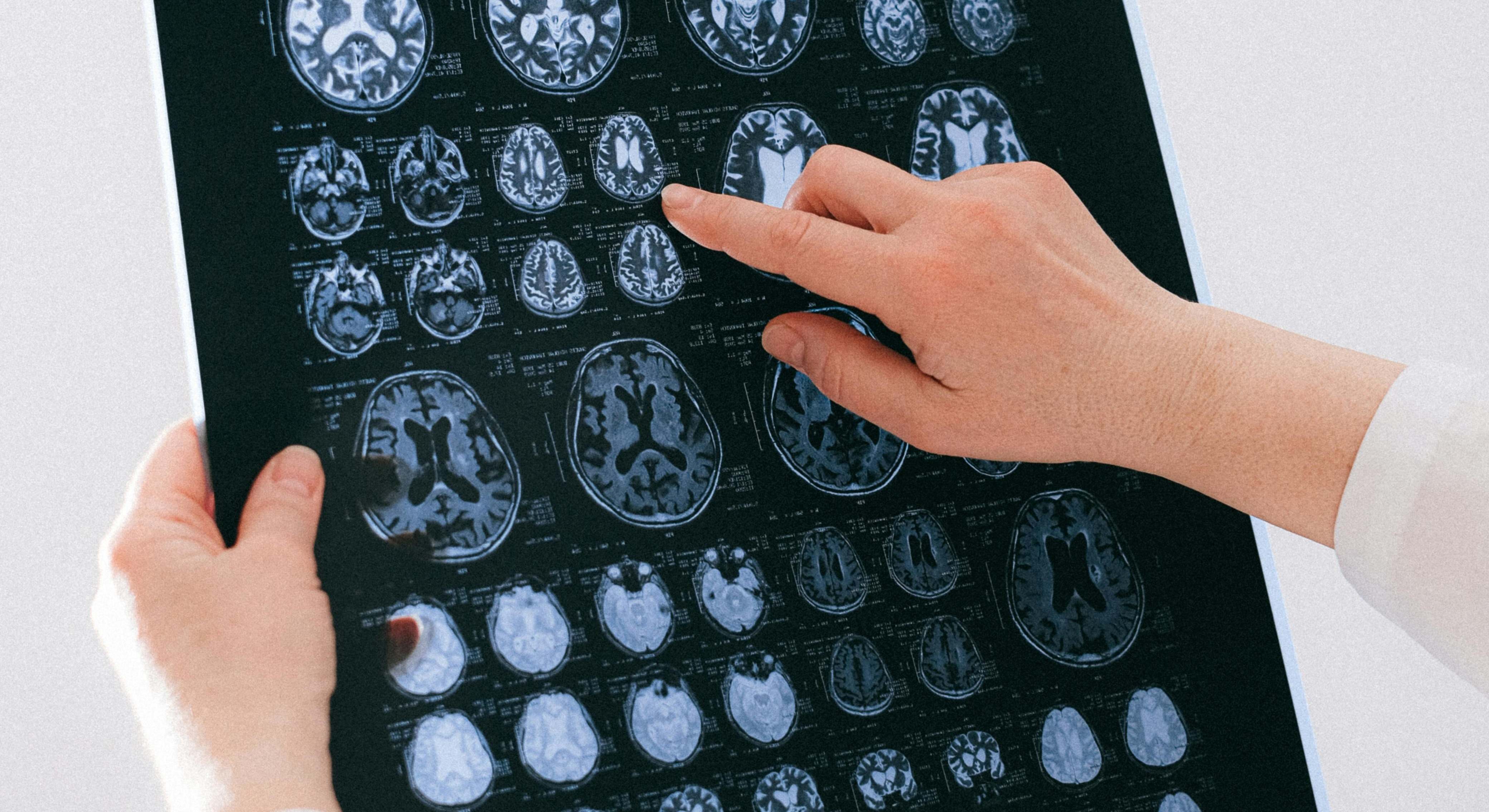 Un tumor cerebral es una colección anormal de células que crece en, o alrededor del, cerebro