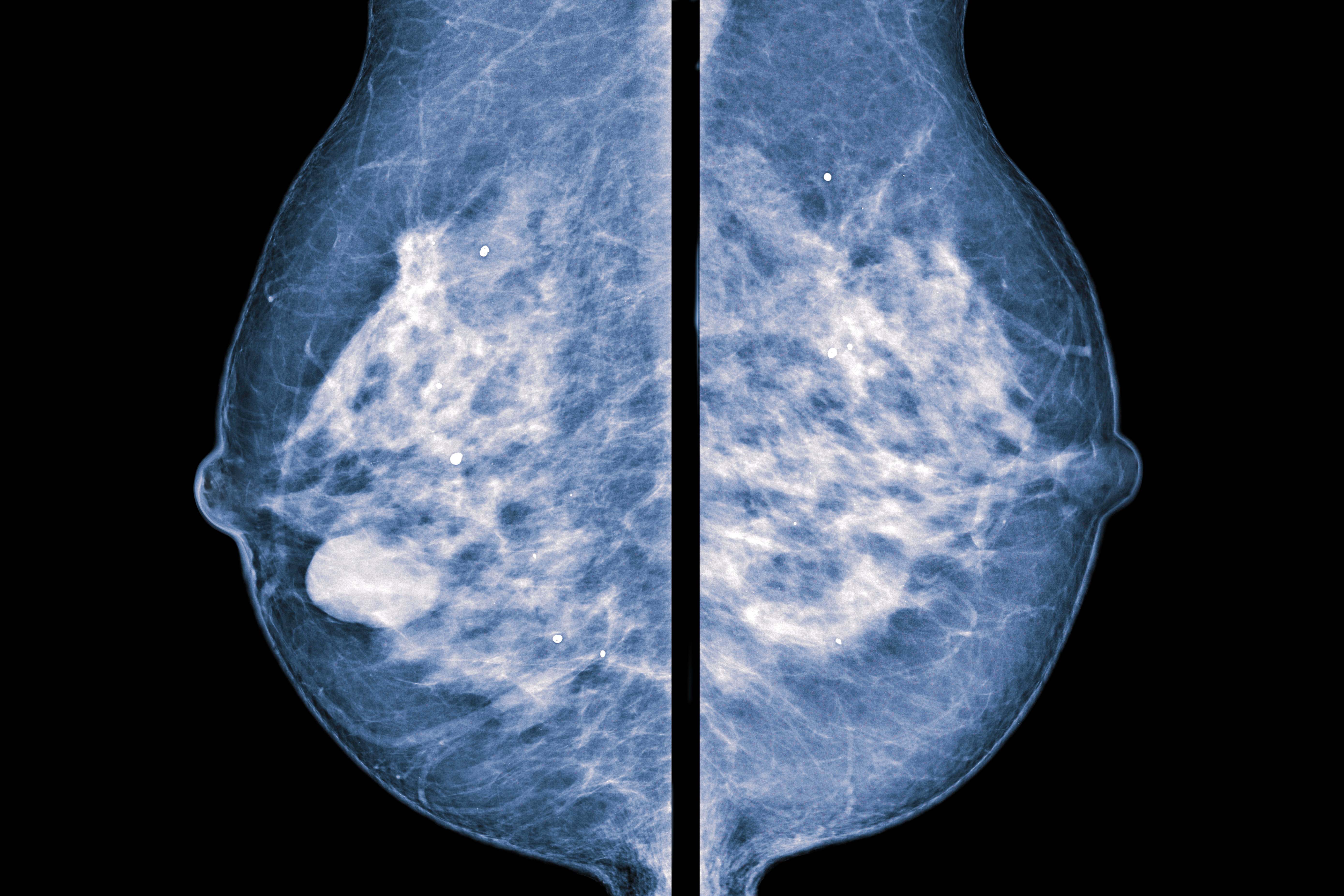 Cáncer de mama