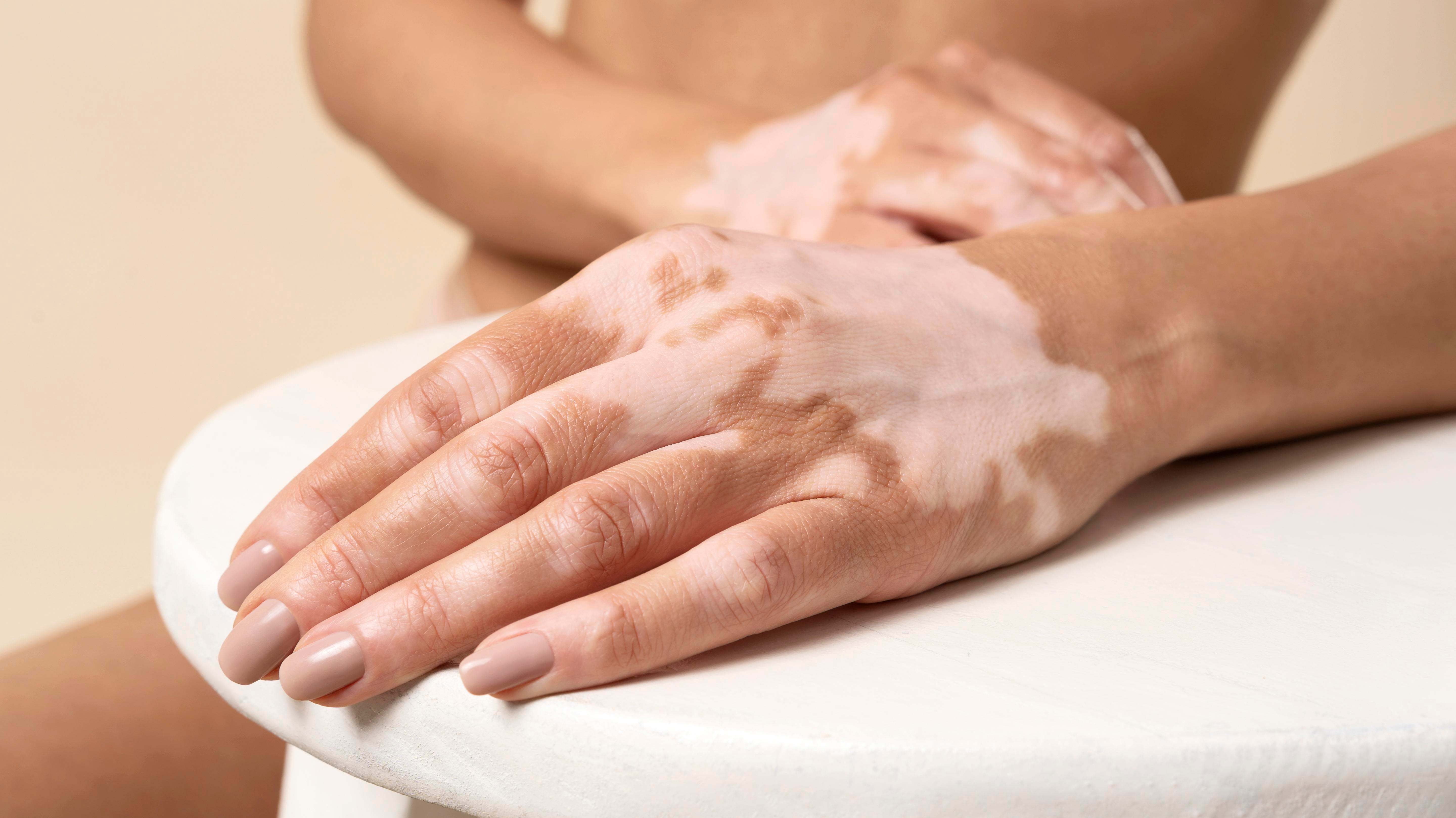 Vitiligo_Sesderma.jpg