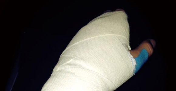 Casillas-mano-2013-lesion-escayola.jpg