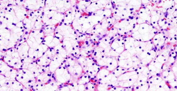 cancer-rinon-sinc.jpg